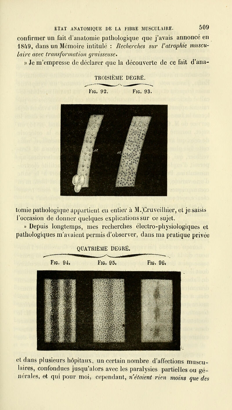 confirmer un fait d'anatomie pathologique que j'avais annoncé en 18^9, dans un Mémoire intitulé : Recherches sur l'atrophie muscu- laire avec transformation graisseuse. » Je m'empresse de déclarer que la découverte de ce fait d'ana- TROISIÈME DEGRÉ. FiG. 92. FiG. 93. tomie pathologique appartient eu entier à M.|Cruveilliier, et je saisis l'occasion de donner quelques explications sur ce sujet. » Depuis longtemps, mes recherches électro-physiologiques et pathologiques m'avaient permis d'observer, dans ma pratique privée QUATRIÈME DEGRÉ. FiG. 94. FiG, 95. FiG. 96. et dans plusieurs hôpitaux, un certain nombre d'affections muscu- laires, confondues jusqu'alors avec les paralysies partielles ou gé- nérales, et qui pour moi, cependant, n étaient rien moins que des