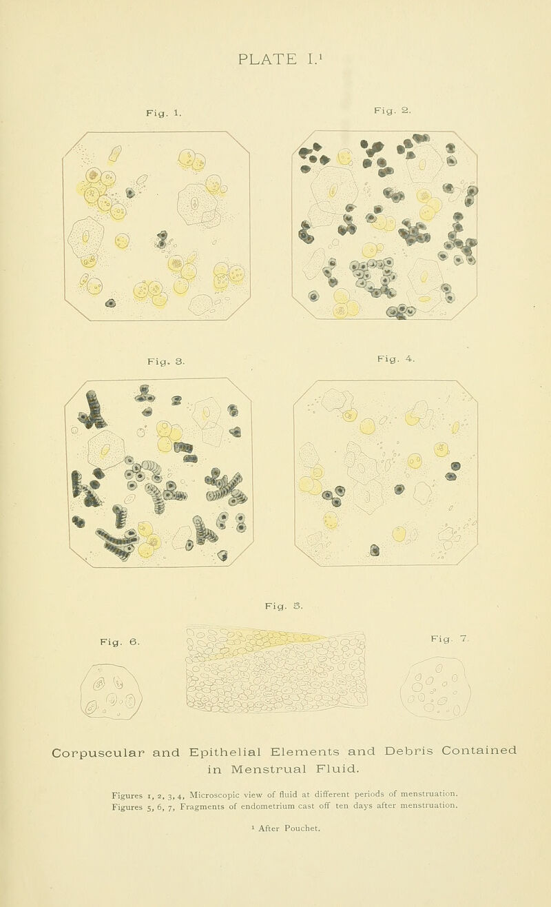 Fig. 1. 0 n © L Fig. 2. .•♦ ••. •y^r* VI Fig. 4. Fig. S. Fig. 6. ^.^ Fig. 7. Corpuscular and Epithelial Elements and Debris Contained in Menstrual Fluid. Figures i, 2, 3, 4, Microscopic view of fluid at different periods of menstruation. Figures 5, 6, 7, Fragments of endometrium cast oif ten days after menstruation. ^ After Pouchet.