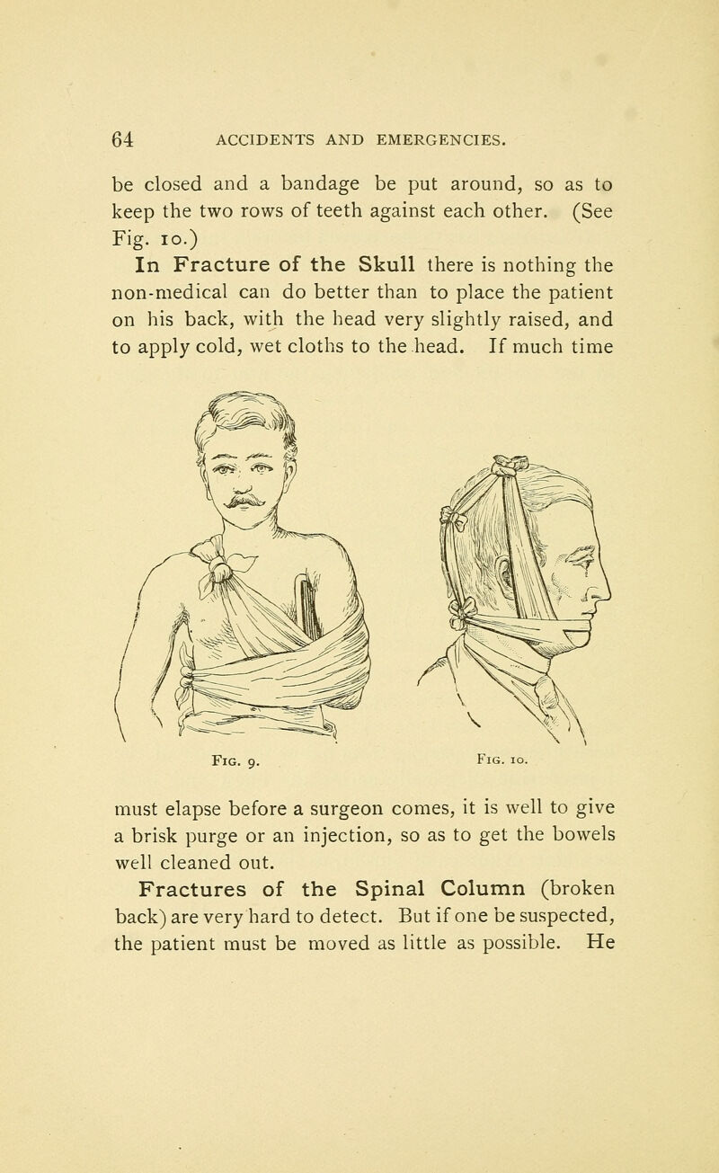 be closed and a bandage be put around, so as to keep the two rows of teeth against each other. (See Fig. lo.) In Fracture of the Skull there is nothing the non-medical can do better than to place the patient on his back, with the head very slightly raised, and to apply cold, wet cloths to the head. If much time Fig. 9. Fig. 10. must elapse before a surgeon comes, it is well to give a brisk purge or an injection, so as to get the bowels well cleaned out. Fractures of the Spinal Column (broken back) are very hard to detect. But if one be suspected, the patient must be moved as little as possible. He