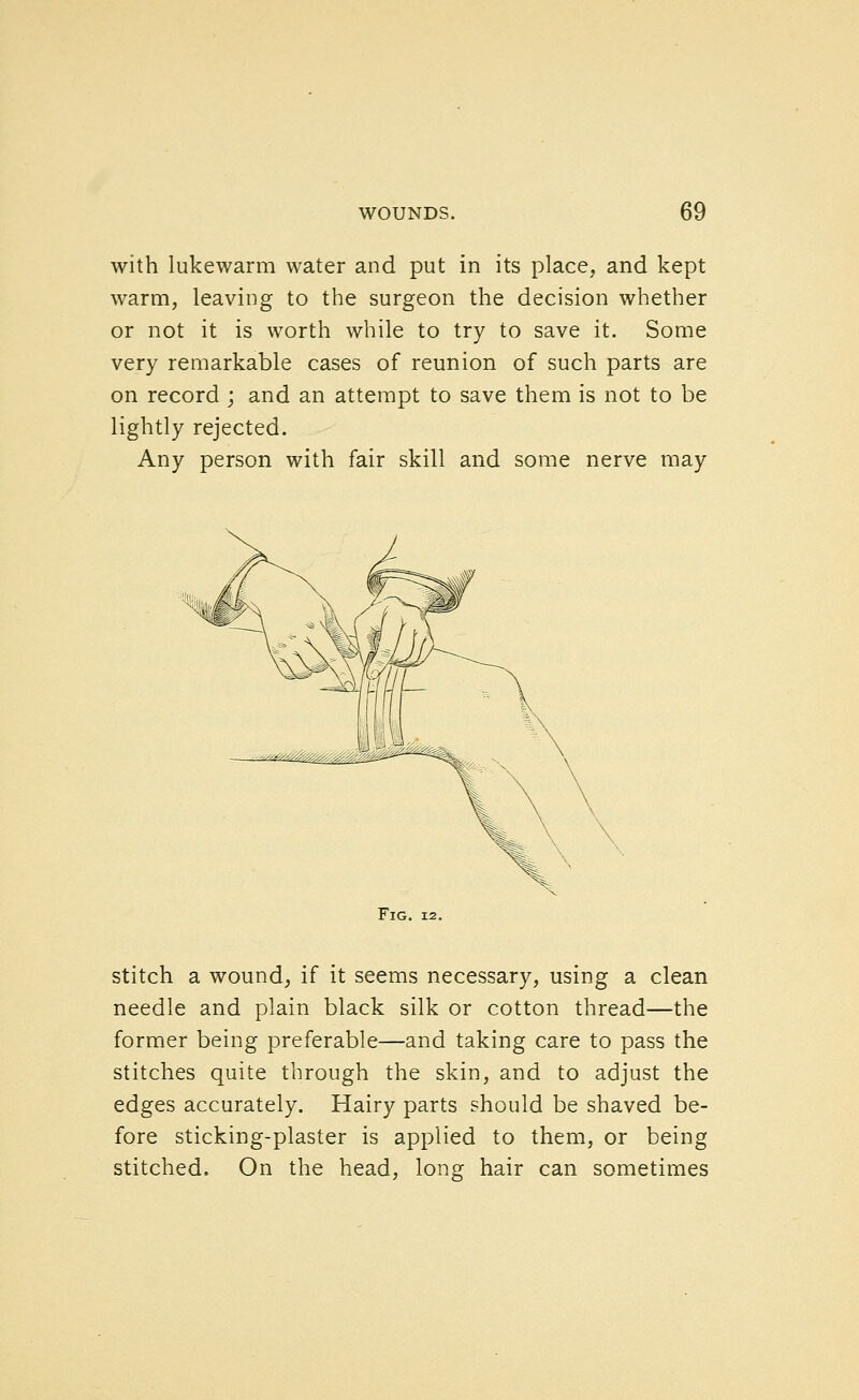 with lukewarm water and put in its place, and kept warm, leaving to the surgeon the decision whether or not it is worth while to try to save it. Some very remarkable cases of reunion of such parts are on record ; and an attempt to save them is not to be lightly rejected. Any person with fair skill and some nerve may Fig. 12. Stitch a wound, if it seems necessary, using a clean needle and plain black silk or cotton thread—the former being preferable—and taking care to pass the stitches quite through the skin, and to adjust the edges accurately. Hairy parts should be shaved be- fore sticking-plaster is applied to them, or being stitched. On the head, long hair can sometimes