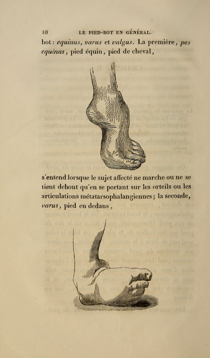 bot: equimiSy varus et valgus. La première, pes cquinus, pied équin ? pied de cheval, s'entend lorsque le sujet affecté ne marche ou ne se tient debout qu'en se portant sur les orteils ou les articulations métatarsophalangiennes; la seconde, varus, pied en dedans,