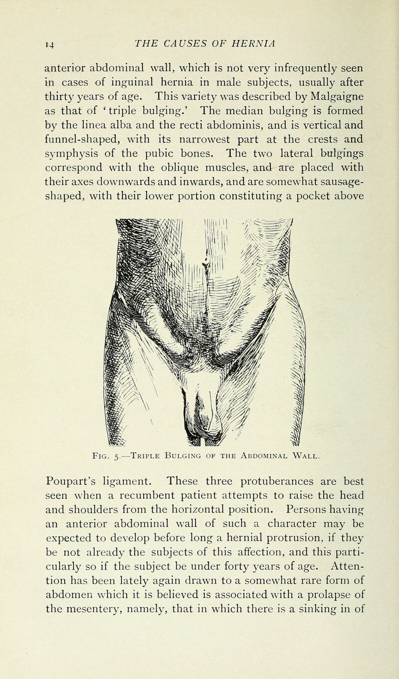 H anterior abdominal wall, which is not very infrequently seen in cases of inguinal hernia in male subjects, usually after thirty years of age. This variety was described by Malgaigne as that of ' triple bulging.' The median bulging is formed by the linea alba and the recti abdominis, and is vertical and funnel-shaped, with its narrowest part at the crests and symphysis of the pubic bones. The two lateral bulgings correspond with the oblique muscles, and are placed with their axes downwards and inwards, and are somewhat sausage- shaped, with their lower portion constituting a pocket above Fig. 5.—Triple Bulging of the Abdominal Wall. Poupart's ligament. These three protuberances are best seen when a recumbent patient attempts to raise the head and shoulders from the horizontal position. Persons having an anterior abdominal wall of such a character may be expected to develop before long a hernial protrusion, if they be not already the subjects of this affection, and this parti- cularly so if the subject be under forty years of age. Atten- tion has been lately again drawn to a somewhat rare form of abdomen which it is believed is associated with a prolapse of the mesentery, namely, that in which there is a sinking in of