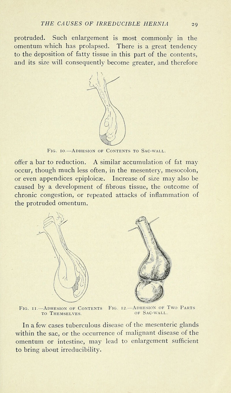 protruded. Such enlargement is most commonly in the omentum which has prolapsed. There is a great tendency to the deposition of fatty tissue in this part of the contents, and its size will consequently become greater, and therefore Fig. 10.—Adhesion of Contents to Sac-wall. offer a bar to reduction. A similar accumulation of fat may occur, though much less often, in the mesentery, mesocolon, or even appendices epiploicas. Increase of size may also be caused by a development of fibrous tissue, the outcome of chronic congestion, or repeated attacks of inflammation of the protruded omentum. Fig. II. —Adhesion of Contents TO Themselves. Fig. 12.—Adhesion of Two Parts OF Sac-wall. In a few cases tuberculous disease of the mesenteric glands within the sac, or the occurrence of malignant disease of the omentum or intestine, may lead to enlargement sufficient to bring about irreducibility.