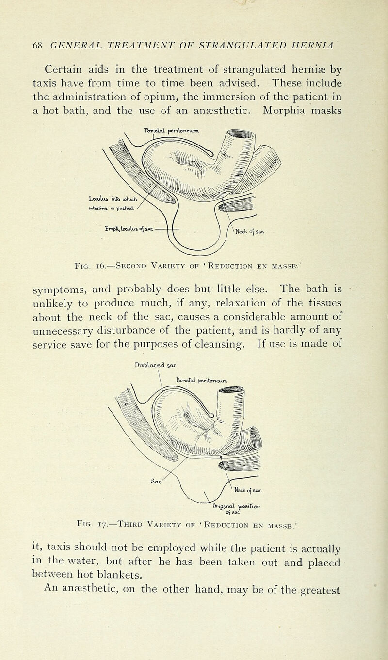 Certain aids in the treatment of strangulated hernise by taxis have from time to time been advised. These include the administration of opium, the immersion of the patient in a hot bath, and the use of an anaesthetic. Morphia masks ToTletaL peTvtffnftuum Loculu^ into uKicK Itti^jThIiXuIuS oj iK. * Neck o] 5ac. Fig. i5.—Second Variety of ' Reduction en masse-.' symptoms, and probably does but little else. The bath is unlikely to produce much, if any, relaxation of the tissues about the neck of the sac, causes a considerable amount of unnecessary disturbance of the patient, and is hardly of any service save for the purposes of cleansing. If use is made of DislpLoteA sac of sac Fig. 17.—Third Variety of 'Reduction en masse.' it, taxis should not be employed while the patient is actually in the water, but after he has been taken out and placed between hot blankets. An anaesthetic, on the other hand, may be of the greatest