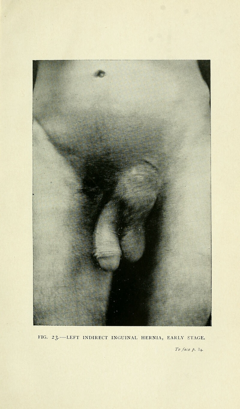 FIG. 23. LEFT INDIRECT INGUINAL HERNIA, EARLY STAGE.