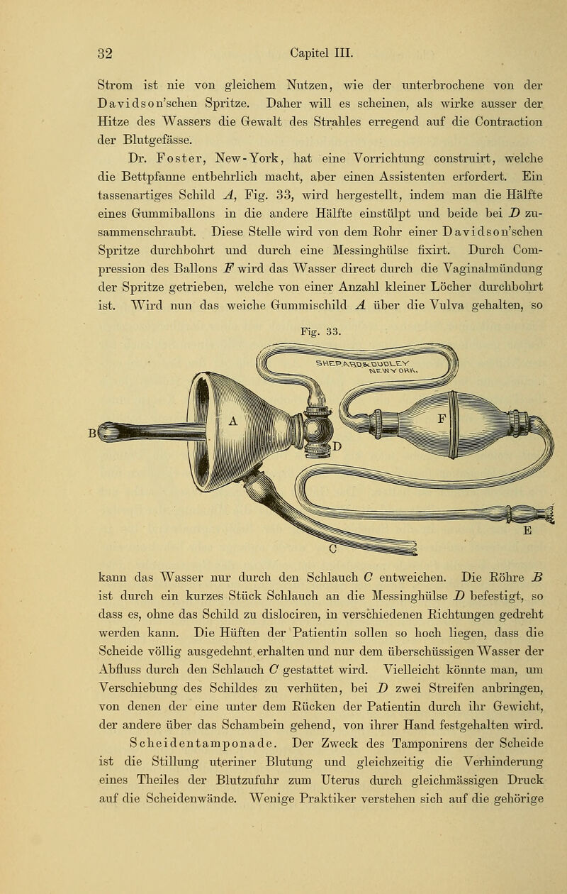 Strom ist nie von gleichem Nutzen, wie der unterbrochene von der Davidson'schen Spritze. Daher will es scheinen, als wirke ausser der Hitze des Wassers die Gewalt des Strahles erregend auf die Contraction der Blutgefässe. Dr. Foster, New-York, hat eine Vorrichtung construirt, welche die Bettpfanne entbehrlich macht, aber einen Assistenten erfordert. Ein tassenartiges Schild A, Fig. 33, wird hergestellt, indem man die Hälfte eines Grummiballons in die andere Hälfte einstülpt und beide bei D zu- sammenschraubt. Diese Stelle wird von dem Bohr einer Davidson'schen Spritze durchbohrt und durch eine Messinghülse fixirt. Durch Com- pression des Ballons F wird das Wasser direct durch die Vaginalmündung der Spritze getrieben, welche von einer Anzahl kleiner Löcher durchbohrt ist. Wird nun das weiche Gummischild A über die Vulva gehalten, so Fig. 33. kann das Wasser nur durch den Schlauch G entweichen. Die Bohre B ist durch ein kurzes Stück Schlauch an die Messinghülse D befestigt, so dass es, ohne das Schild zu dislociren, in verschiedenen Bichtungen gedreht werden kann. Die Hüften der Batientin sollen so hoch liegen, dass die Scheide völlig ausgedehnt, erhalten und nur dem überschüssigen Wasser der Abfluss durch den Schlauch G gestattet wird. Vielleicht könnte man, um Verschiebung des Schildes zu verhüten, bei _D zwei Streifen anbringen, von denen der eine unter dem Bücken der Batientin durch ihr Gewicht, der andere über das Schambein gehend, von ihrer Hand festgehalten wird. Scheidentamponade. Der Zweck des Tamponirens der Scheide ist die Stillung uteriner Blutung und gleichzeitig die Verhinderung eines Theiles der Blutzufuhr zum Uterus durch gleichmässigen Druck auf die Scheidenwände. Wenige Fraktiker verstehen sich auf die gehörige