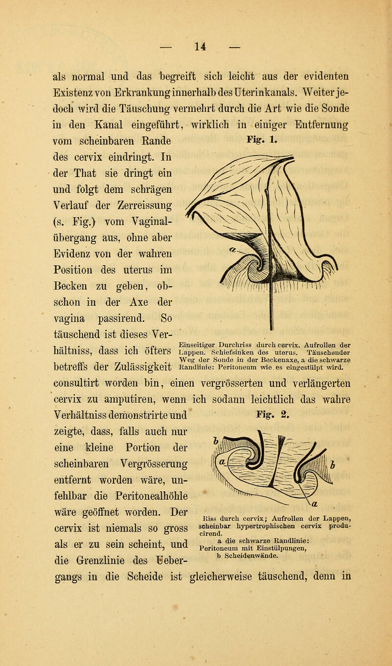 als normal und das begreift sich leicht aus der evidenten Existenz von Erkrankung innerhalb des Uterinkanals. Weiter je- doch wird die Täuschung vermehrt durch die Art wie die Sonde in den Kanal eingeführt, wirklich in einiger Entfernung vom scheinbaren Bande Fig. 1. des cervix eindringt. In der That sie dringt ein und folgt dem schrägen Verlauf der Zerreissung (s. Fig.) vom Vaginal- übergang aus, ohne aber Evidenz von der wahren Position des uterus im Becken zu geben, ob- schon in der Axe der vagina passirend. So täuschend ist dieses Ver- ,..,,. , . , „p. Einseitiger Durchriss durch cervix. Aufrollen der nältniSS, ClaSS lCil ÖltOrS Lappen. Schiefsinken des uterus. Täuschender . , . Weg der Sonde in der Beckenaxe, a die schwarze betreffs der ZuläSSlgkeit Randlinie: Peritoneum wie es eingestülpt wird. consultirt worden bin, einen vergrößerten und verlängerten cervix zu amputiren, wenn ich sodann leichtlich das wahre Verhältniss demonstrirte und Fig. 2, zeigte, dass, falls auch nur eine kleine Portion der scheinbaren Vergrösserung entfernt worden wäre, un- fehlbar die Peritonealhöhle wäre geöffnet worden. Der cervix ist niemals so gross als er zu sein scheint, und die Grenzlinie des Ueber- gangs in die Scheide ist gleicherweise täuschend, denn in Riss durch cervix; Aufrollen der Lappen, scheinbar hypertrophischen cervix produ- cirend. a die schwarze Randlinie: Peritoneum mit Einstülpungen, b Scheidenwände.
