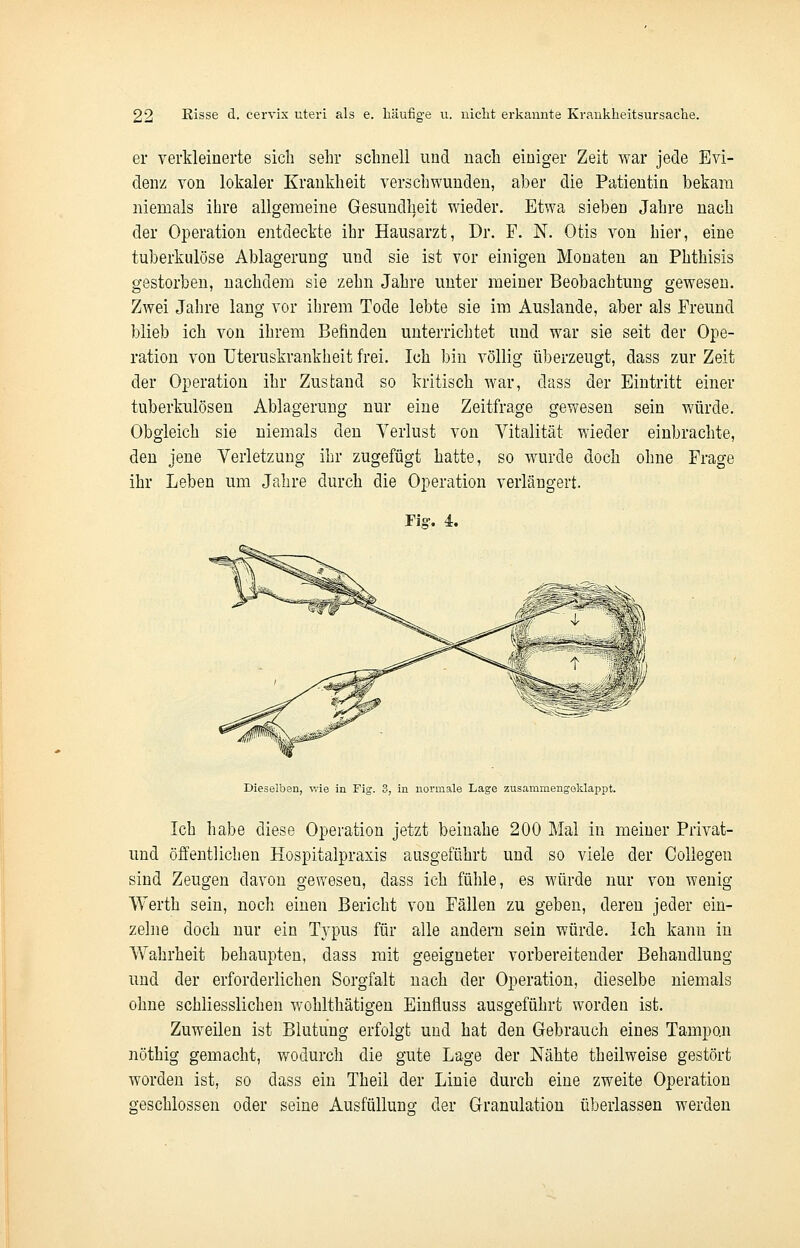 er verkleinerte sich sehr schnell und nach einiger Zeit war jede Evi- denz von lokaler Krankheit verschwunden, aber die Patientin bekam niemals ihre allgemeine Gesundheit wieder. Etwa sieben Jahre nach der Operation entdeckte ihr Hausarzt, Dr. F. N. Otis von hier, eine tuberkulöse Ablagerung und sie ist vor einigen Monaten an Phthisis gestorben, nachdem sie zehn Jahre unter meiner Beobachtung gewesen. Zwei Jahre lang vor ihrem Tode lebte sie im Auslande, aber als Freund blieb ich von ihrem Befinden unterrichtet und war sie seit der Ope- ration von Uteruskrankheit frei. Ich bin völlig überzeugt, dass zur Zeit der Operation ihr Zustand so kritisch war, dass der Eintritt einer tuberkulösen Ablagerung nur eine Zeitfrage gewesen sein würde. Obgleich sie niemals den Verlust von Vitalität wieder einbrachte, den jene Verletzung ihr zugefügt hatte, so wurde doch ohne Frage ihr Leben um Jahre durch die Operation verlängert. Fisr. i. Dieselben, wie in Fig. 3, in normale Lage zusammengeklappt. Ich habe diese Operation jetzt beinahe 200 Mal in meiner Privat- und öffentlichen Hospitalpraxis ausgeführt und so viele der Collegen sind Zeugen davon geweseu, dass ich fühle, es würde nur von wenig Werth sein, noch einen Bericht von Fällen zu geben, deren jeder ein- zelne doch nur ein Typus für alle andern sein würde. Ich kann in Wahrheit behaupten, dass mit geeigneter vorbereitender Behandlung und der erforderlichen Sorgfalt nach der Operation, dieselbe niemals ohne schliesslichen wohlthätigen Einfluss ausgeführt worden ist. Zuweilen ist Blutung erfolgt und hat den Gebrauch eines Tampon nöthig gemacht, wodurch die gute Lage der Nähte theilweise gestört worden ist, so dass ein Theil der Linie durch eine zweite Operation geschlossen oder seine Ausfüllung der Granulation überlassen werden