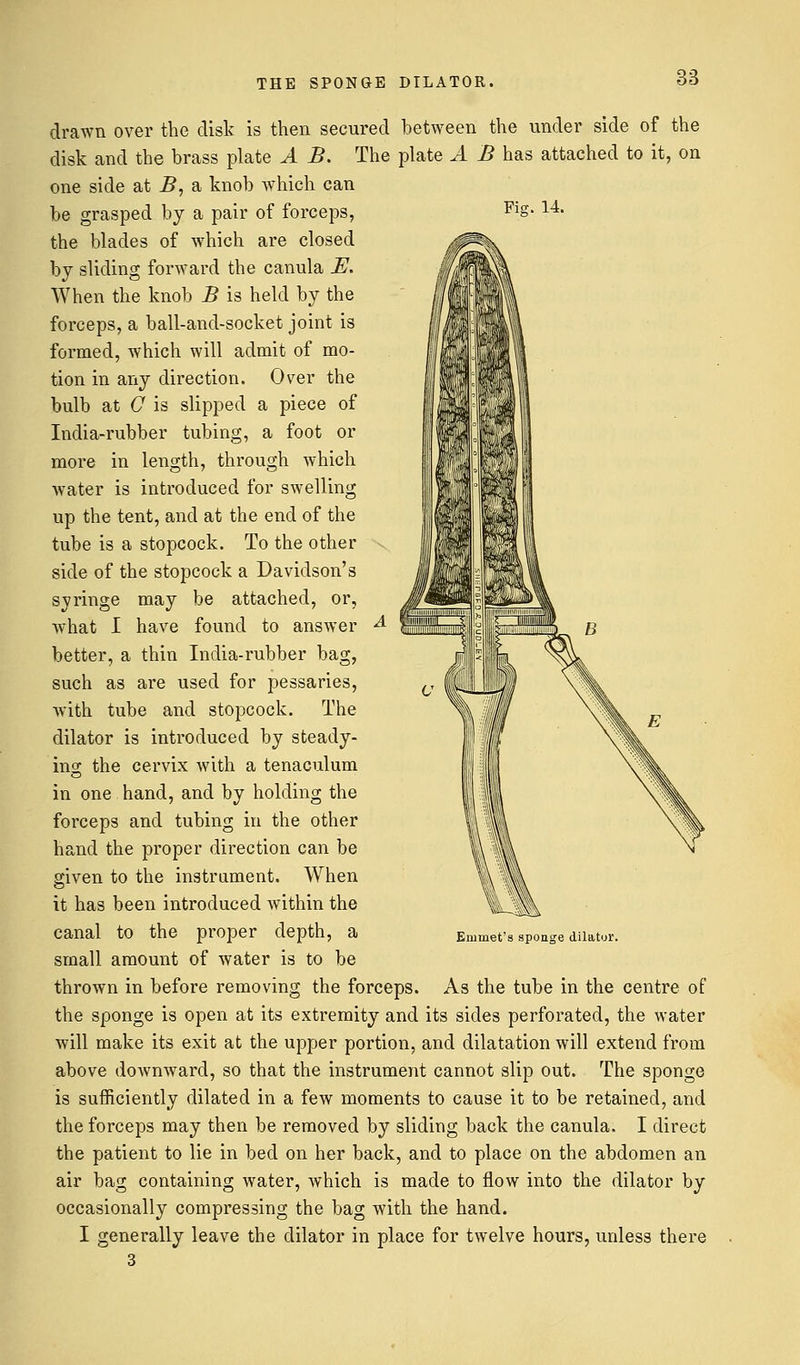 THE SPONGE DILATOR. Fig. 14. drawn over the disk is then secured between the under side of the disk and the brass plate A B. The plate A B has attached to it, on one side at B, a knob which can be grasped by a pair of forceps, the blades of which are closed by sliding forward the canula E. When the knob B is held by the forceps, a ball-and-socket joint is formed, which will admit of mo- tion in any direction. Over the bulb at C is slipped a piece of India-rubber tubing, a foot or more in length, through which water is introduced for swelling up the tent, and at the end of the tube is a stopcock. To the other side of the stopcock a Davidson's syringe may be attached, or, what I have found to answer * better, a thin India-rubber bag, such as are used for pessaries, with tube and stopcock. The dilator is introduced by steady- ing the cervix with a tenaculum in one hand, and by holding the forceps and tubing in the other hand the proper direction can be given to the instrument. When it has been introduced within the canal to the proper depth, a small amount of water is to be thrown in before removing the forceps. As the tube in the centre of the sponge is open at its extremity and its sides perforated, the water will make its exit at the upper portion, and dilatation will extend from above downward, so that the instrument cannot slip out. The sponge is sufficiently dilated in a few moments to cause it to be retained, and the forceps may then be removed by sliding back the canula. I direct the patient to lie in bed on her back, and to place on the abdomen an air bag containing water, which is made to flow into the dilator by occasionally compressing the bag with the hand. I generally leave the dilator in place for twelve hours, unless there 3 Emmet's sponge dilator.