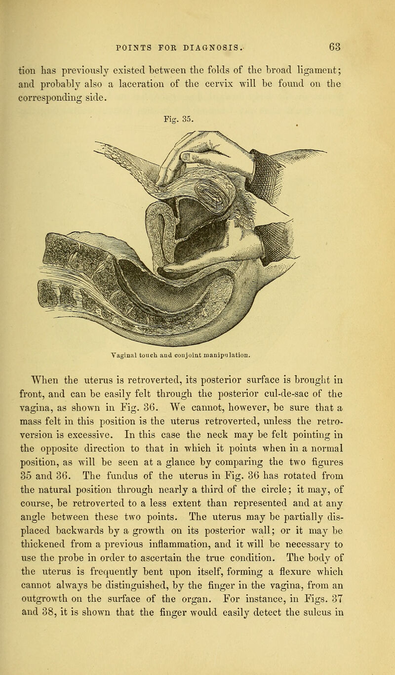 tion has previously existed between the folds of the broad ligament; and probably also a laceration of the cervix will be found on the corresponding side. Fisr. 35. Vaginal touch and conjoint manipulation. When the uterus is retroverted, its posterior surface is brought in front, and can be easily felt through the posterior cul-de-sac of the vagina, as shown in Fig. 36. We cannot, however, be sure that a mass felt in this position is the uterus retroverted, unless the retro- version is excessive. In this case the neck may be felt pointing in the opposite direction to that in which it points when in a normal position, as will be seen at a glance by comparing the two figures 35 and 36. The fundus of the uterus in Fig. 36 has rotated from the natural position through nearly a third of the circle; it may, of course, be retroverted to a less extent than represented and at any angle between these two points. The uterus may be partially dis- placed backwards by a growth on its posterior wall; or it may be thickened from a previous inflammation, and it will be necessary to use the probe in order to ascertain the true condition. The body of the uterus is frequently bent upon itself, forming a flexure which cannot always be distinguished, by the finger in the vagina, from an outgrowth on the surface of the organ. For instance, in Figs. 3T and 38, it is shown that the finger would easily detect the sulcus in