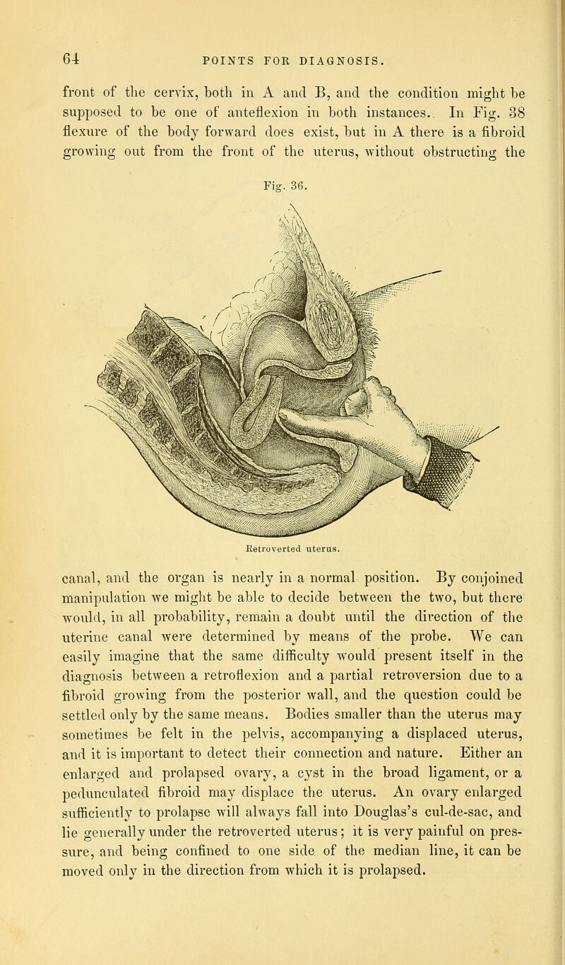 front of the cervix, both in A and B, and the condition might be supposed to be one of anteflexion in both instances.. In Fig. 38 flexure of the body forward does exist, but in A there is a fibroid growing out from the front of the uterus, without obstructing the Fie. 36. Retroverted uterus. canal, and the organ is nearly in a normal position. By conjoined manipulation we might be able to decide between the two, but there would, in all probability, remain a doubt until the direction of the uterine canal were determined by means of the probe. We can easily imagine that the same difficulty would present itself in the diagnosis between a retroflexion and a partial retroversion due to a fibroid growing from the posterior wall, and the question could be settled only by the same means. Bodies smaller than the uterus may sometimes be felt in the pelvis, accompanying a displaced uterus, and it is important to detect their connection and nature. Either an enlarged and prolapsed ovary, a cyst in the broad ligament, or a pedunculated fibroid may displace the uterus. An ovary enlarged sufficiently to prolapse will always fall into Douglas's cul-de-sac, and lie generally under the retroverted uterus; it is very painful on pres- sure, and being confined to one side of the median line, it can be moved only in the direction from which it is prolapsed.
