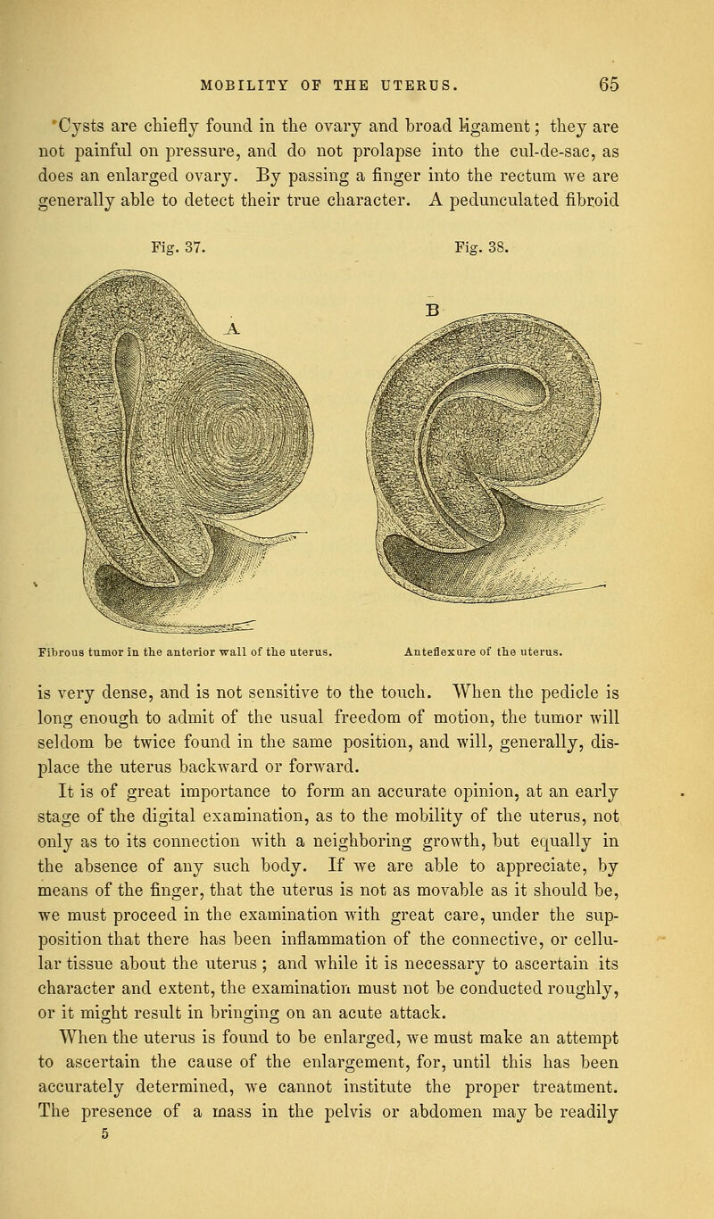 Cysts are chiefly found in the ovary and broad ligament; they are not painful on pressure, and do not prolapse into the cul-de-sac, as does an enlarged ovary. By passing a finger into the rectum we are generally able to detect their true character. A pedunculated fibroid Fig. 37. Fig. 38. Fibrous tumor in the anterior wall of the uterus. Anteflexure of the uterus. is very dense, and is not sensitive to the touch. When the pedicle is long enough to admit of the usual freedom of motion, the tumor will seldom be twice found in the same position, and will, generally, dis- place the uterus backward or forward. It is of great importance to form an accurate opinion, at an early stage of the digital examination, as to the mobility of the uterus, not only as to its connection with a neighboring growth, but equally in the absence of any such body. If we are able to appreciate, by means of the finger, that the uterus is not as movable as it should be, we must proceed in the examination with great care, under the sup- position that there has been inflammation of the connective, or cellu- lar tissue about the uterus ; and while it is necessary to ascertain its character and extent, the examination must not be conducted roughly, or it might result in bringing on an acute attack. When the uterus is found to be enlarged, we must make an attempt to ascertain the cause of the enlargement, for, until this has been accurately determined, we cannot institute the proper treatment. The presence of a mass in the pelvis or abdomen may be readily 5