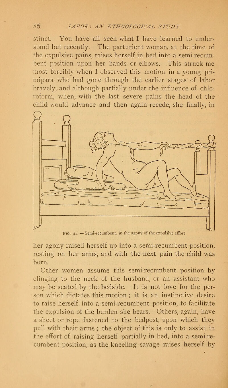 stinct. You have all seen what I have learned to under- stand but recently. The parturient woman, at the time of the expulsive pains, raises herself in bed into a semi-recum- bent position upon her hands or elbows. This struck me most forcibly when I observed this motion in a young pri- mipara who had gone through the earlier stages of labor bravely, and although partially under the influence of chlo- roform, when, with the last severe pains the head of the child would advance and then again recede, she finally, in Fig. 41. —Semi-recumbent, in tlie agony of the expulsive effort her agony raised herself up into a semi-recumbent position, resting on her arms, and with the next pain the child was born. Other women assume this semi-recumbent position by clinging to the neck of the husband, or an assistant who may be seated by the bedside. It is not love for the per- son which dictates this motion; it is an instinctive desire to raise herself into a semi-recumbent position, to facilitate the expulsion of the burden she bears. Others, again, have a sheet or rope fastened to the bedpost, upon which they pull with their arms ; the object of this is only to assist in the effort of raising herself partially in bed, into a semi-re- cumbent position, as the kneeling savage raises herself by