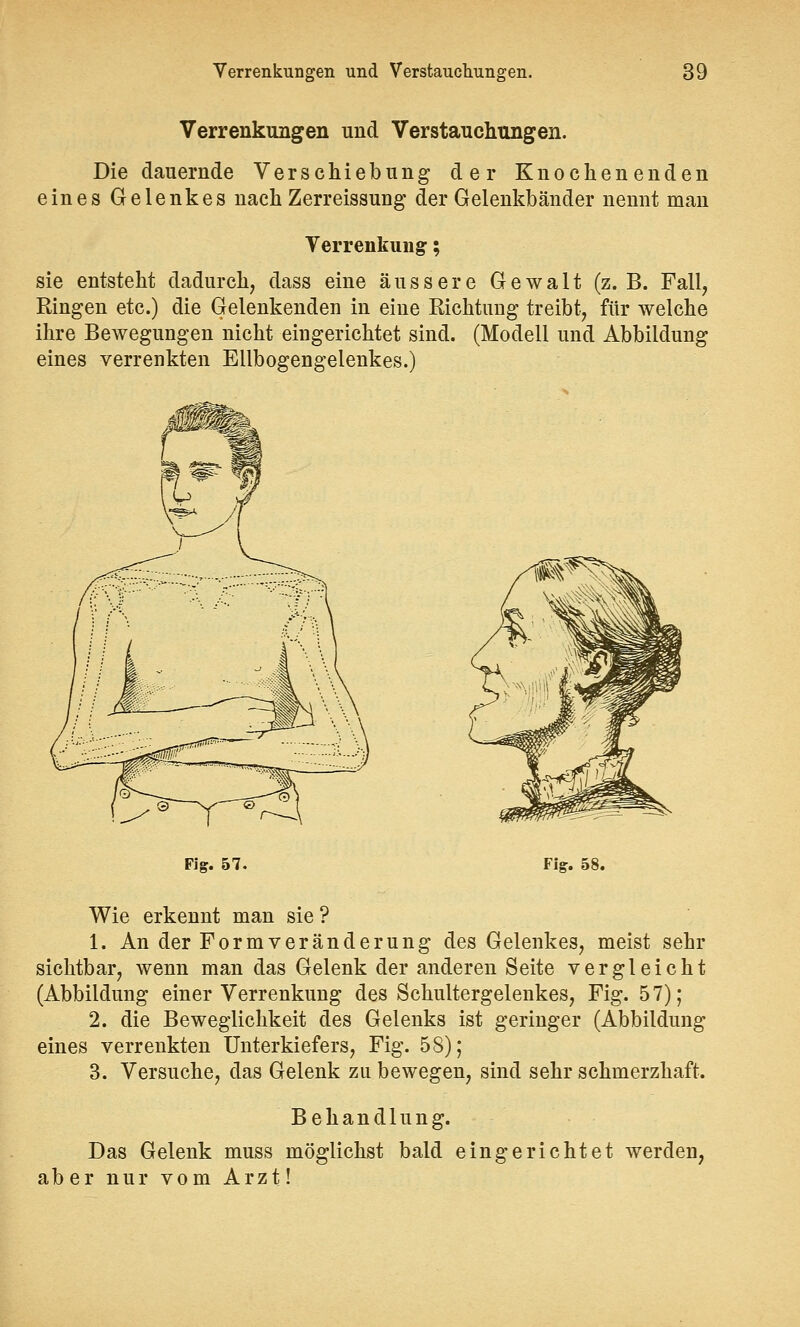 Verrenkungen und Verstauchungen. Die dauernde Verschiebung der Knochenenden eines Gelenkes nach Zerreissung der Gelenkbänder nennt man Verrenkung; sie entsteht dadurch, dass eine äussere Gewalt (z.B. Fall, Ringen etc.) die Gelenkenden in eine Richtung treibt, für welche ihre Bewegungen nicht eingerichtet sind. (Modell und Abbildung eines verrenkten Ellbogengelenkes.) Fig. 57. Fig. 58. Wie erkennt man sie ? 1. An der Formveränderung des Gelenkes, meist sehr sichtbar, wenn man das Gelenk der anderen Seite vergleicht (Abbildung einer Verrenkung des Schultergelenkes, Fig. 57); 2. die Beweglichkeit des Gelenks ist geringer (Abbildung eines verrenkten Unterkiefers, Fig. 58); 3. Versuche, das Gelenk zu bewegen, sind sehr schmerzhaft. Behandlung. Das Gelenk muss möglichst bald eingerichtet werden, aber nur vom Arzt!