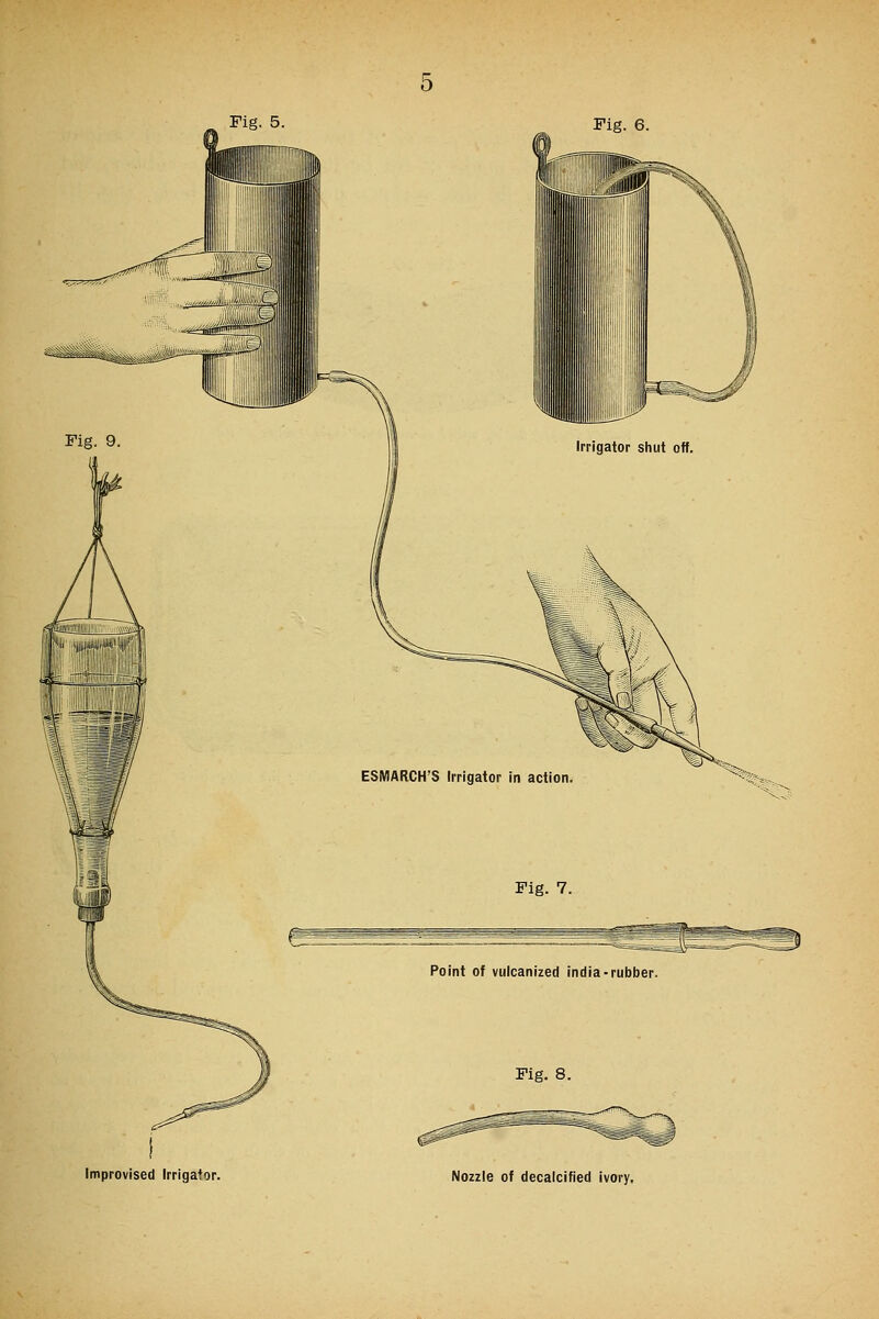 Improvised Irrigator. Nozzle of decalcified ivory.