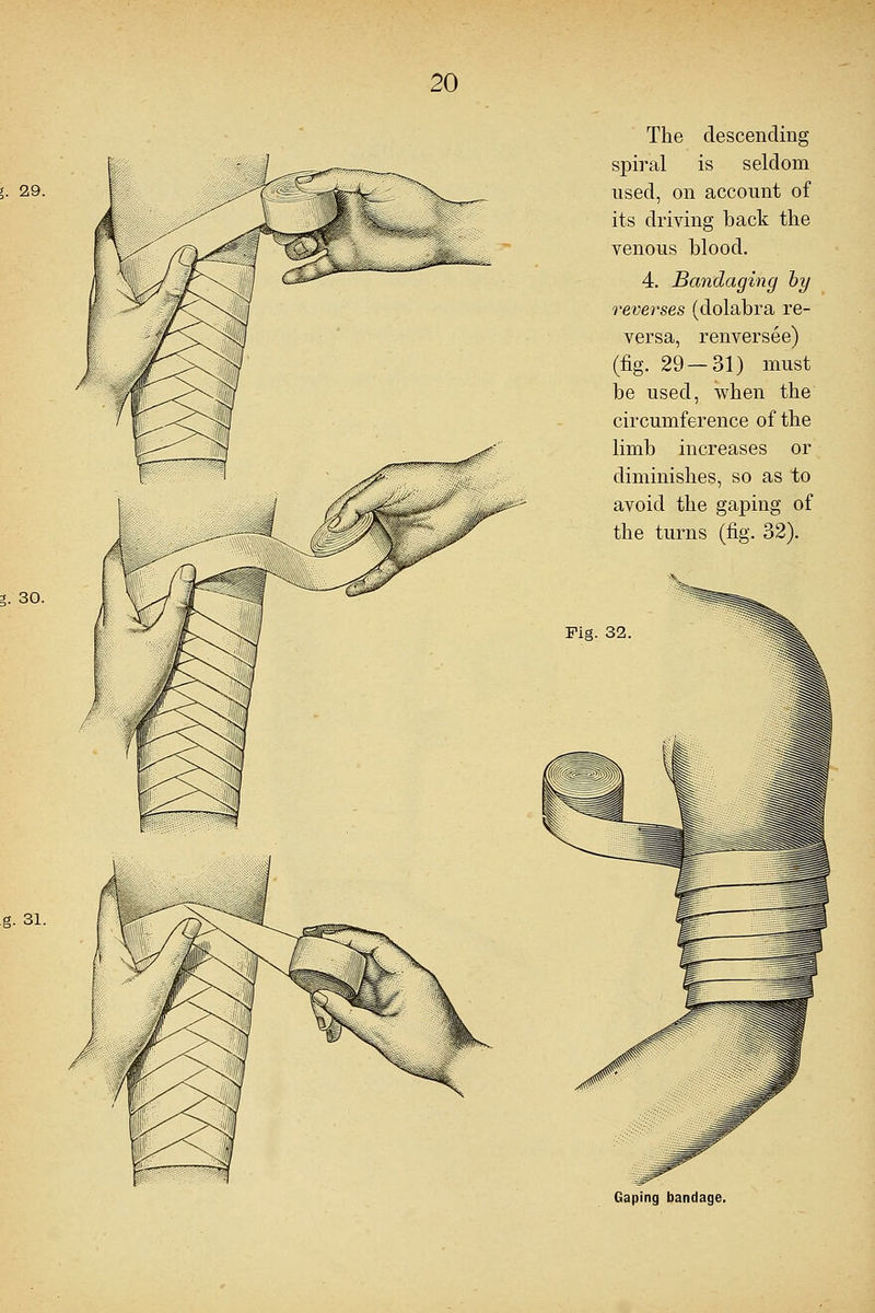 J. 29. * 30. g. 31. The descending spiral is seldom used, on account of its driving back the venous blood. 4. Bandaging by reverses (dolabra re- versa, renversee) (fig. 29—31) must be used, when the circumference of the limb increases or diminishes, so as to avoid the gaping of the turns (fig. 32). Fig. 32 Gaping bandage.