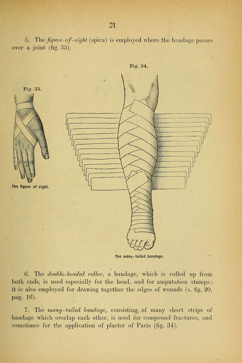 2\ 5. The figure- of- eight (spica) is employed where the bandage passes over a joint (fig. 33). Fig. 34. Fig. 33. The figure of eight. The many-tailed bandage. 6. The double-headed roller, a bandage, which is rolled up from both ends, is used especially for the head, and for amputation stumps; it is also employed for drawing together the edges of wounds (s. fig. 20, pag. 16). 7. The many - tailed bandage, consisting of many short strips of bandage which overlap each other, is used for compound fractures, and sometimes for the application of plaster of Paris (fig. 34).