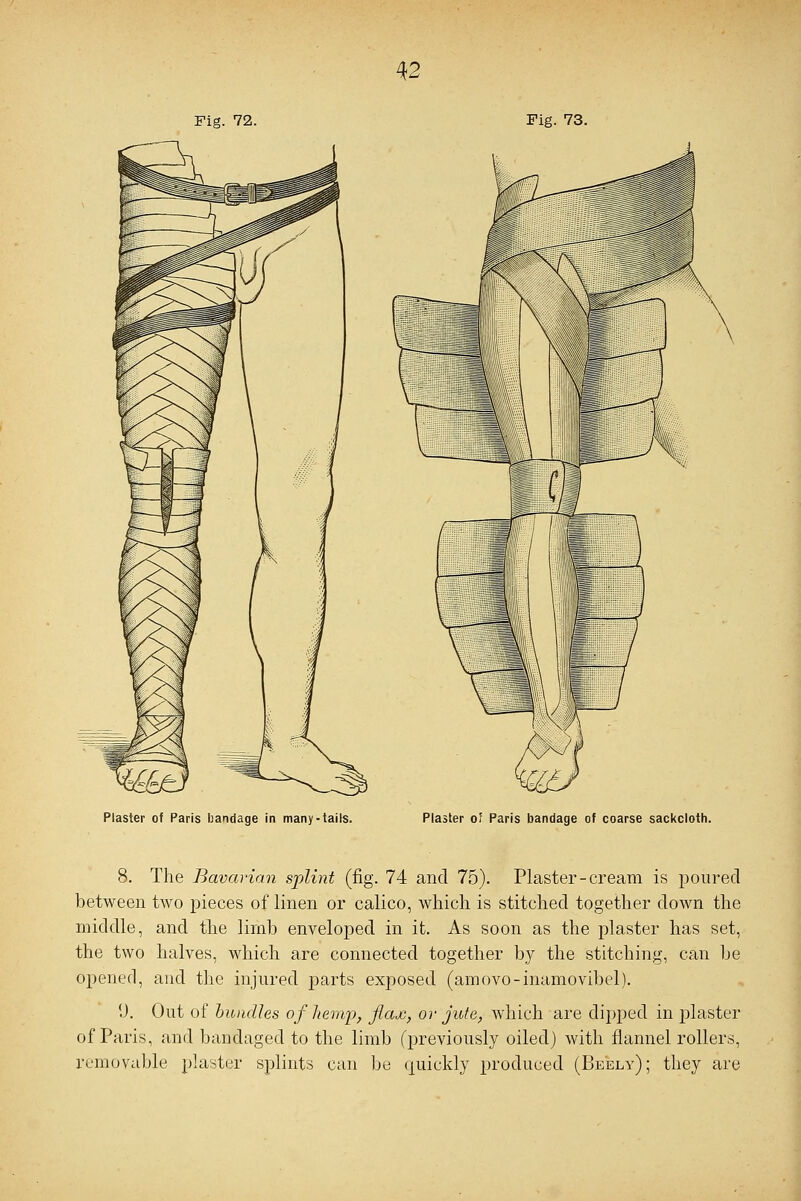 Fig. 72. Fig. 73. Plaster of Paris bandage in many-tails. Plaster o' Paris bandage of coarse sackcloth. 8. The Bavarian splint (fig. 74 and 75). Plaster - cream is poured between two pieces of linen or calico, which is stitched together clown the middle, and the limb enveloped in it. As soon as the plaster has set, the two halves, which are connected together by the stitching, can be opened, and the injured parts exposed (amovo-inamovibel). 9. Out of bundles of hemp, flax, or jute, which are dipped in plaster of Paris, and bandaged to the limb (previously oiled) with flannel rollers, removable plaster splints can be quickly produced (Beely); they are