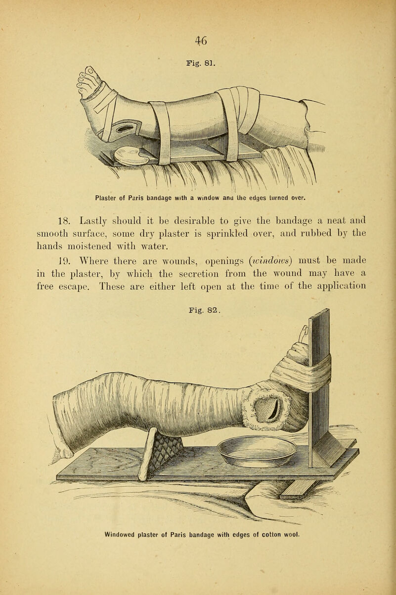 Fig. 81 Plaster of Paris bandage with a window anu the edges turned over. 18. Lastly should it be desirable to give the bandage a neat and smooth surface, some dry plaster is sprinkled over, and rubbed by the hands moistened with water. 19. Where there are wounds, openings {windows) must be made in the plaster, by which the secretion from the wound may have a free escape. These are either left open at the time of the application Fig. 82 Windowed plaster of Paris bandage with edges of cotton wool.