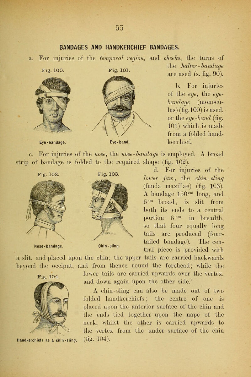 00 Fig. 100. Fig. 101. BANDAGES AND HANDKERCHIEF BANDAGES. a. For injuries of the temporal region, and cheeks, the turns of the halter - bandage are used (s. fig. 90). b. For injuries of the eye, the eye- bandage (monocu- lus) (fig. 100) is used, or the eye-band (fig. 101) which is made from a folded hand- kerchief. Eye-bandage. Eye-band. c. For injuries of the nose, the nose-bandage is employed. A broad strip of bandage is folded to the required shape (fig. 102). d. For injuries of the Fig. 102. Fig. 103. Nose-bandage. Fig. 104. Chin-sling. lower jaw, the chin-sling (funda maxillae) (fig. 103). A bandage 150cm long, and gem broad, is slit from both its ends to a central portion 6cm in breadth, so that four equally long tails are produced (four- tailed bandage). The cen- tral piece is provided with a slit, and placed upon the chin; the upper tails are carried backwards beyond the occiput, and from thence round the forehead; while the lower tails are carried upwards over the vertex, and down again upon the other side. A chin-sling can also be made out of two folded handkerchiefs; the centre of one is placed upon the anterior surface of the chin and the ends tied together upon the nape of the neck, whilst the other is carried upwards to the vertex from the under surface of the chin Handkerchiefs as a cnin-sling. (tig. 104J.