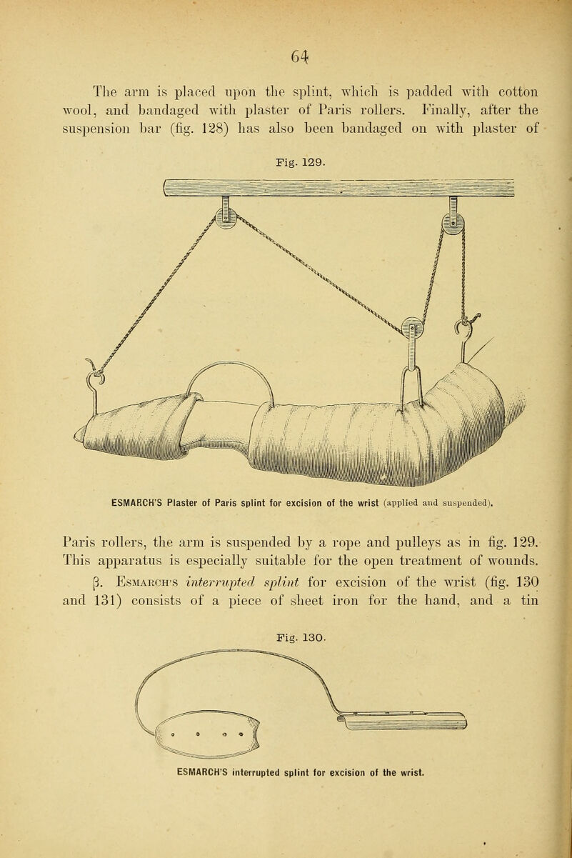 The arm is placed upon the splint, which is padded with cotton wool, and bandaged with plaster of Paris rollers. Finally, after the suspension bar (fig. 128) has also been bandaged on with plaster of Fig. 129. ESMARCH'S Plaster of Paris splint for excision of the wrist (applied and suspended). Paris rollers, the arm is suspended by a rope and pulleys as in fig. 129. This apparatus is especially suitable for the open treatment of wounds. p. Esmaroh's interrupted splint for excision of the wrist (fig. 130 and 131) consists of a piece of sheet iron for the hand, and a tin Fig. 130. ESMARCH'S interrupted splint for excision of the wrist.