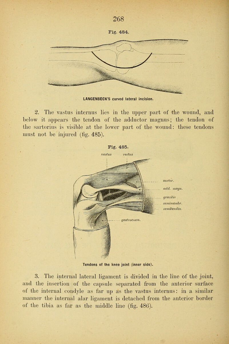 Fig. 484. LANGENBECK'S curved lateral incision. 2. The vastus interims lies in the upper part of the wound, and below it appears the tendon of the adductor magnus; the tendon of the sartorius is visible at the lower part of the wound: these tendons must not be injured (fig. 485). Fig. 485. vastus rectus Tendons of the knee joint (inner side). 3. The internal lateral ligament is divided in the line of the joint, and the insertion of the capsule separated from the anterior surface of the internal condyle as far up as the vastus internus: in a similar manner the internal alar ligament is detached from the anterior border of the tibia as far as the middle line (fig. 486).