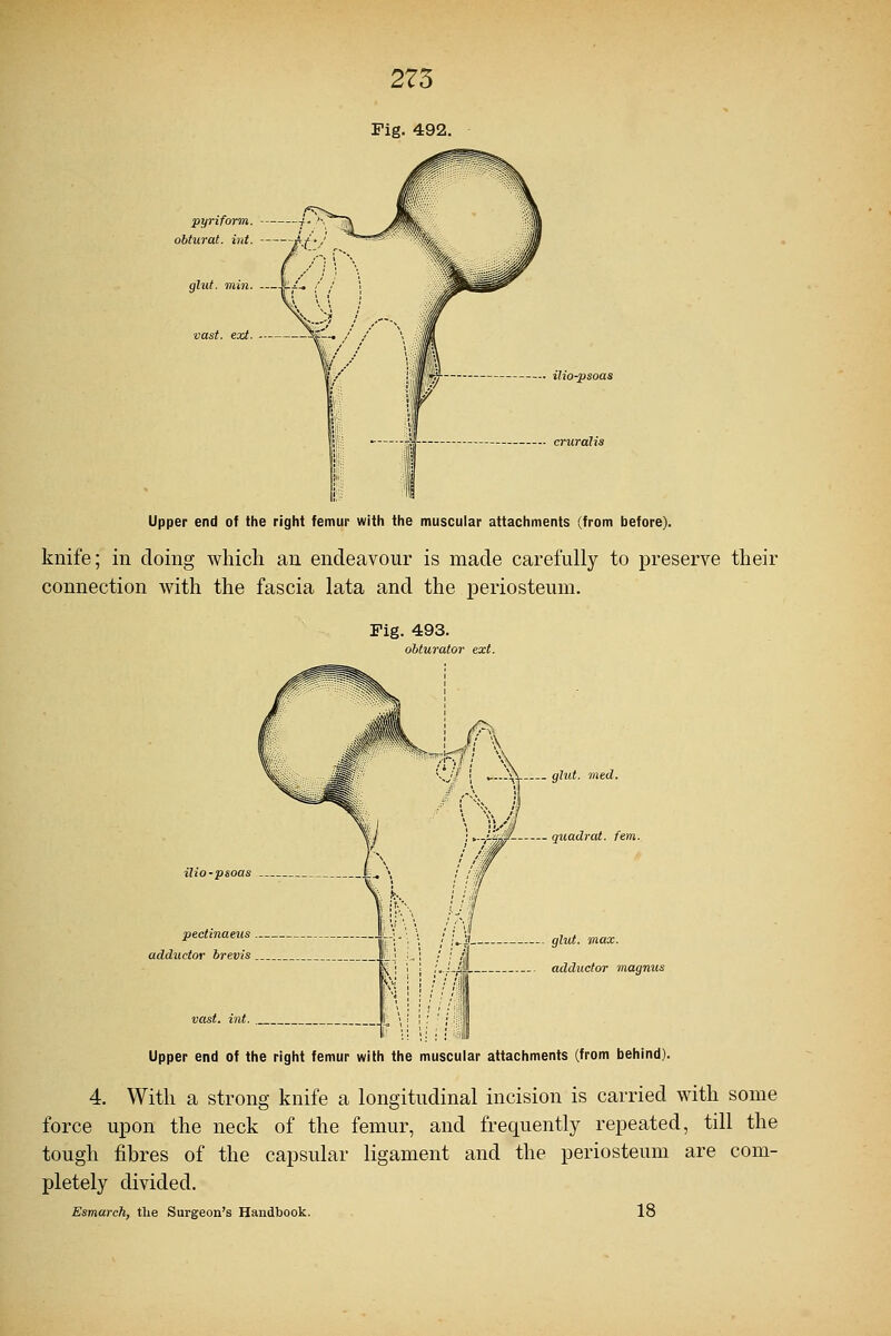 pyriform. — obturat int. — glut. min. — vast. ext. — ilio-psoas Upper end of the right femur with the muscular attachments (from before). knife; in doing which an endeavour is made carefully to preserve their connection with the fascia lata and the periosteum. Fig. 493. obturator ext. ilio-psoas pectinaeus adductor brevis . glut. mtd. quadrat, fern. glut. max. w adductor magnus Upper end of the right femur with the muscular attachments (from behind). 4. With a strong knife a longitudinal incision is carried with some force upon the neck of the femur, and frequently repeated, till the tough fibres of the capsular ligament and the periosteum are com- pletely divided. Esmarch, the Surgeon's Handbook. 18