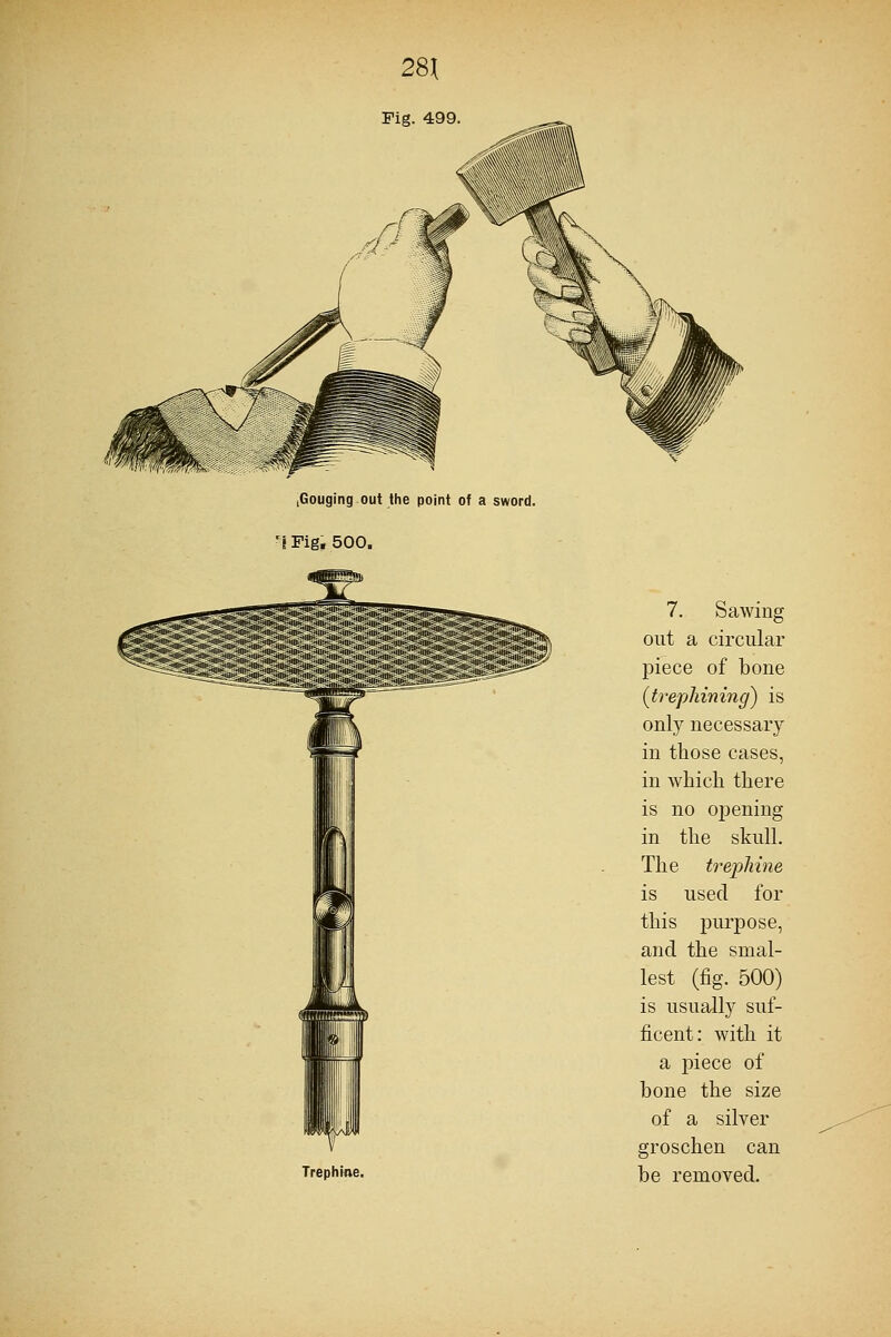 ,Gouging out the point of a sword. r8 Fig. 500. Trephine. 7. Sawing out a circular piece of bone (trephining) is only necessary in those cases, in which there is no opening in the skull. The trephine is used for this purpose, and the smal- lest (fig. 500) is usually suf- ficent: with it a jDiece of bone the size of a silver groschen can be removed.