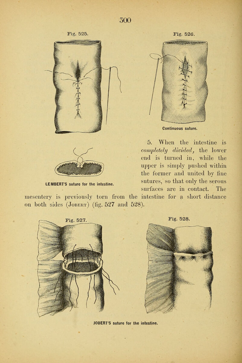 Fig. 525. Fig. 526. LEMBERT'S suture for the intestine. Continuous suture. 5. When the intestine is completely divided, the lower end is turned in, while the upper is simply pushed within the former and united by fine sutures, so that only the serous surfaces are in contact. The mesentery is previously torn from the intestine for a short distance on both sides (Jobert) (fig. 527 and 528). Fig. 527 Fig. 528. JOBERT'S suture for the intestine.