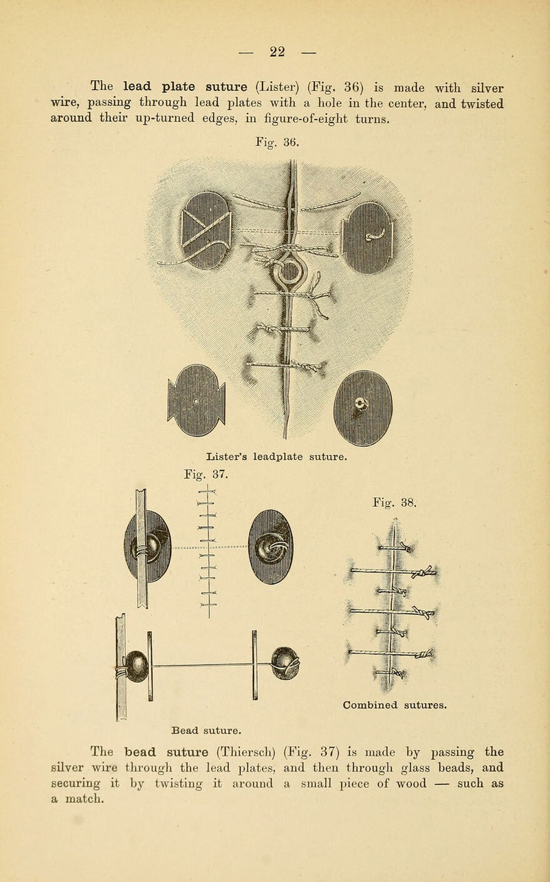 The lead plate suture (Lister) (Fig. 36) is made with silver wire, passing through lead plates with a hole in the center, and twisted around their up-turned edges, in figure-of-eight turns. Fiar. 36. life 'tjillWi!!!!' m m 111 All/1 lit Lister's leadplate suture. Fisr. 37. Fisr. 38. Combined sutures. Bead suture. The bead suture (Thiersch) (Fig. 37) is made by passing the silver wire through the lead plates, and then through glass beads, and securing it by twisting it around a small piece of wood — such as a match.