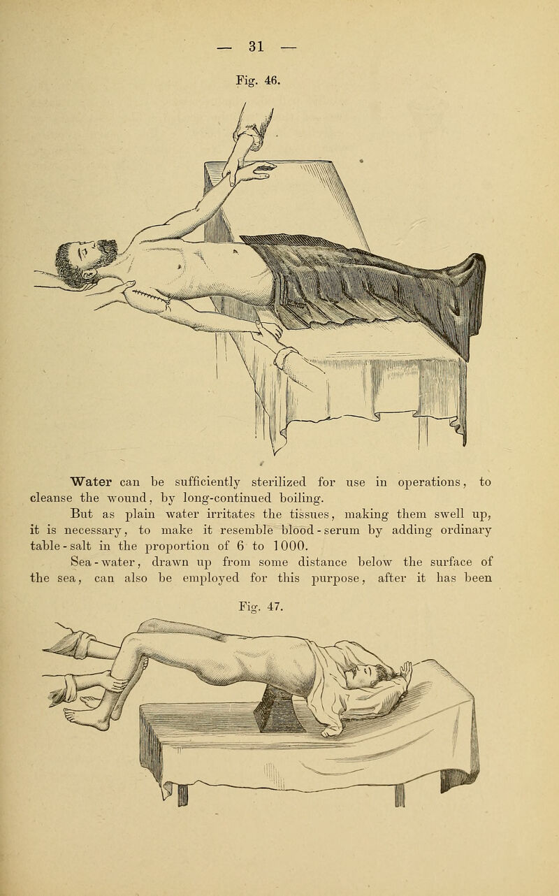 Fig. 46. Water can be sufficiently sterilized for use in operations, to cleanse the wound, by long-continued boiling. But as plain water irritates the tissues, making them swell up, it is necessary, to make it resemble blood - serum by adding ordinary table-salt in the proportion of 6 to 1000. Sea-water, drawn up from some distance below the surface of the sea, can also be employed for this purpose, after it has been Fisr. 47.