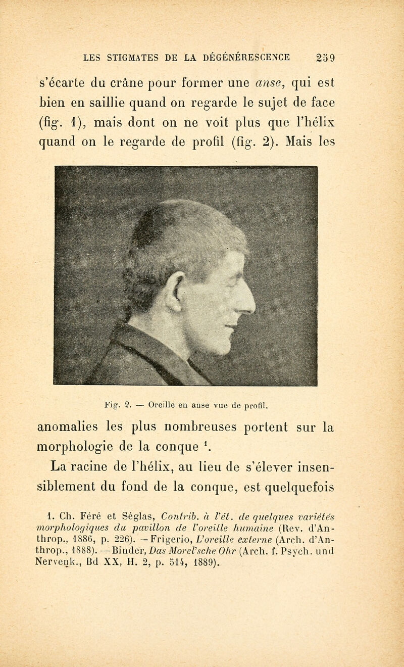 s'écarte du crâne pour former une anse, qui est bien en saillie quand on regarde le sujet de face (fig\ 1), mais dont on ne voit plus que l'hélix quand on le regarde de profil (fîg. 2). Mais les Fig. 2. — Oreille en anse vue de profil. anomalies les plus nombreuses portent sur la morphologie de la conque '.. La racine de l'hélix, au lieu de s'élever insen- siblement du fond de la conque, est quelquefois 1. Ch. Féré et Séglas, Contrib. à Vét. de quelques variétés morphologiques du pavillon de l'oreille humaine (Rev. d'An- throp., 1886, p. 226). — Frïgerio, Voreille externe (Arch. d'An- throp., 1888). — Binder, Das MoreVsche Ohr (Arch. f. Psych. und Nervenk., Bd XX, H. 2, p. 514, 1889).