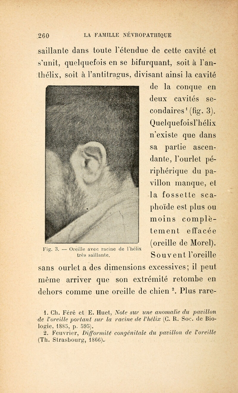 saillante dans toute l'étendue de cette cavité et s'unit, quelquefois en se bifurquant, soit à l'an- thélix, soit à l'antitragus, divisant ainsi la cavité de la conque en deux cavités se- condaires1 (fig. 3). QuelquefoisFhélix n'existe que dans sa partie ascen- dante, l'ourlet pé- riphérique du pa- villon manque, et la fossette sca- phoïde est plus ou moins complè- tement effacée (oreille de Morel). Souvent l'oreille sans ourlet a des dimensions excessives; il peut même arriver que son extrémité retombe en dehors comme une oreille de chien 2. Plus rare- Fig. 3. — Oreille avec racine de l'hélix très saillante. 1. Ch. Féré et E. Huet, Note sur une anomalie du pavillon de Voreille portant sur la racine de Vhélix (G. R. Soc. de Bio- logie, 1885, p. 595). 2. Feuvrier, Difformité congénitale du pavillon de Voreille (Th. Strasbourg, 1866).