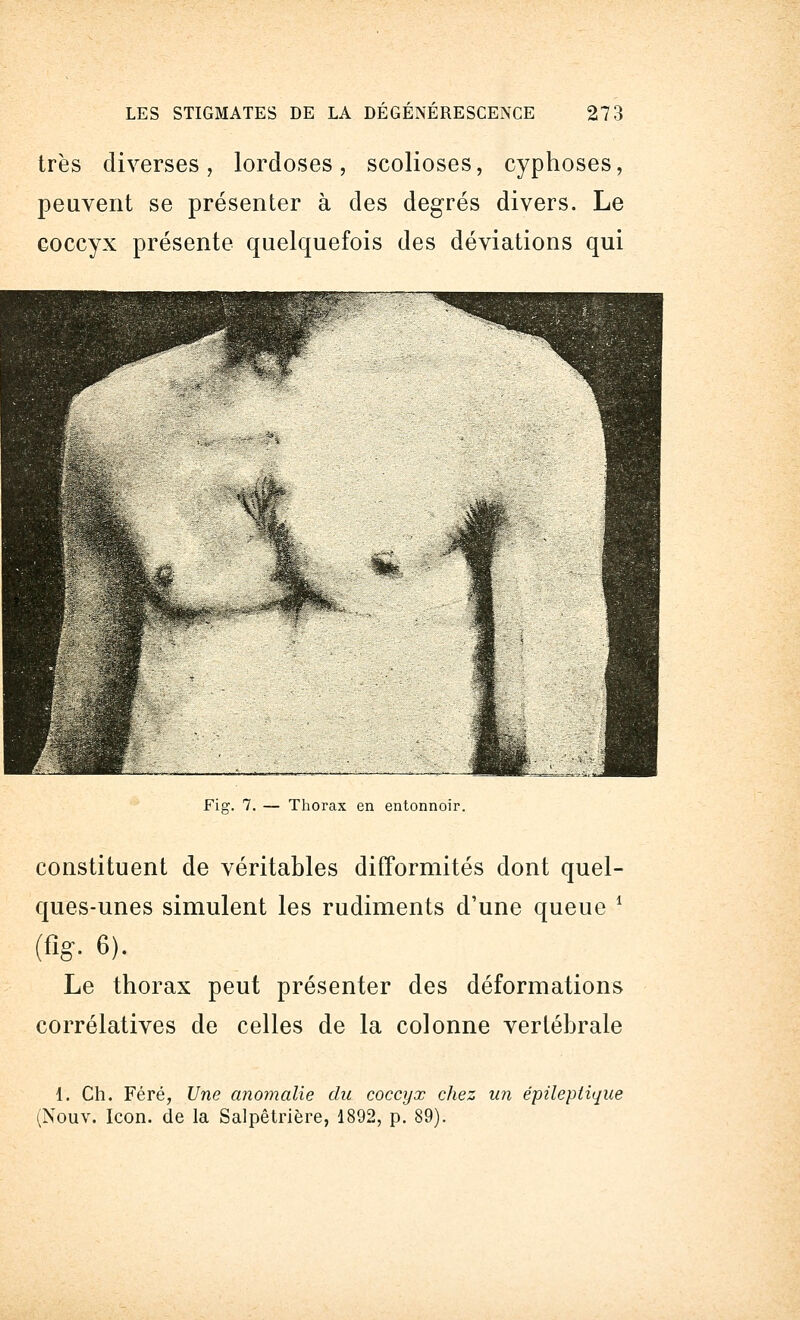 très diverses, lordoses, scolioses, cyphoses, peuvent se présenter à des degrés divers. Le coccyx présente quelquefois des déviations qui Fis. 7. — Thorax en entonnoir. constituent de véritables difformités dont quel- ques-unes simulent les rudiments d'une queue - (%• 6). Le thorax peut présenter des déformations corrélatives de celles de la colonne vertébrale 1. Ch. Féré, Une anomalie du coccyx chez un épileptique (Nouv. Icon. de la Salpêtrière, 1892, p. 89).