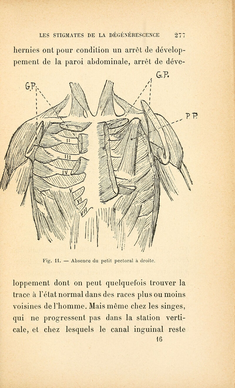 hernies ont pour condition un arrêt de dévelop- pement de la paroi abdominale, arrêt de déve- Fig. 11. — Absence du petit pectoral à droite. loppement dont on peut quelquefois trouver la trace à l'état normal dans des races plus ou moins voisines de l'homme. Mais même chez les singes, qui ne progressent pas dans la station verti- cale, et chez lesquels le canal inguinal reste 16