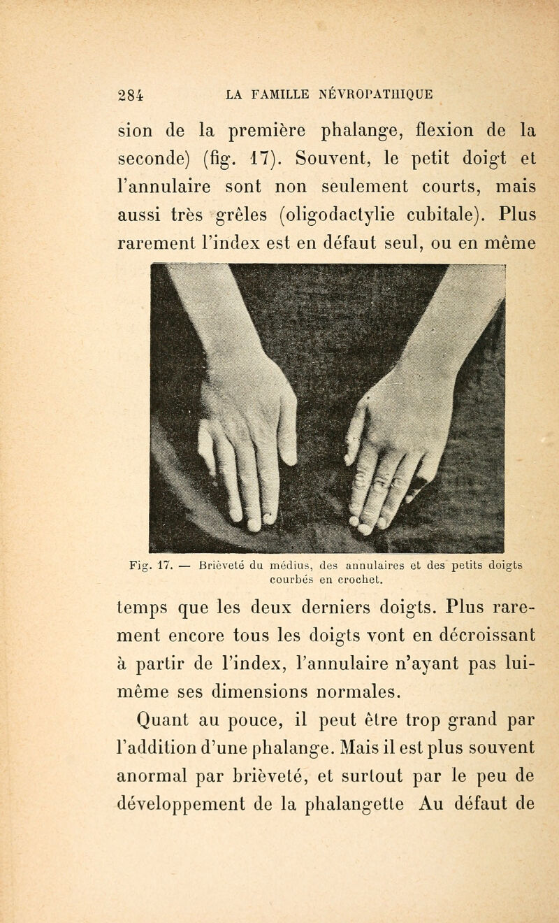 sion de la première phalange, flexion de la seconde) (fig. 17). Souvent, le petit doigt et l'annulaire sont non seulement courts, mais aussi très grêles (oligodactylie cubitale). Plus rarement l'index est en défaut seul, ou en même Fig. 17. — Brièveté du médius, des annulaires et des petits doigts courbés en crochet. temps que les deux derniers doigts. Plus rare- ment encore tous les doigts vont en décroissant à partir de l'index, l'annulaire n'ayant pas lui- même ses dimensions normales. Quant au pouce, il peut être trop grand par l'addition d'une phalange. Mais il est plus souvent anormal par brièveté, et surtout par le peu de développement de la phalangette Au défaut de