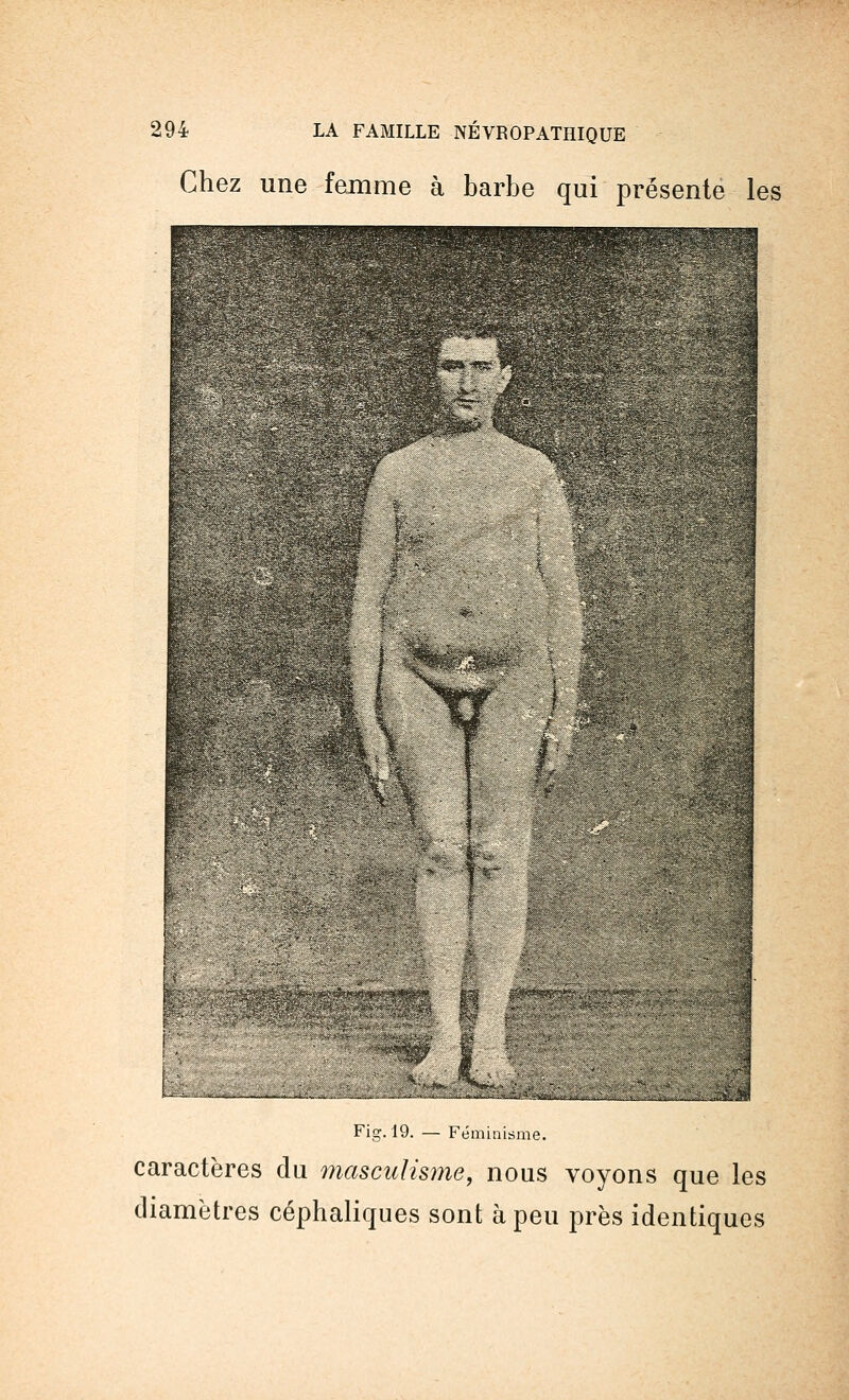 Chez une femme à barbe qui présente les Fig. 19. — Féminisme. caractères du mascuhsnie, nous voyons que les diamètres céphaliques sont à peu près identiques