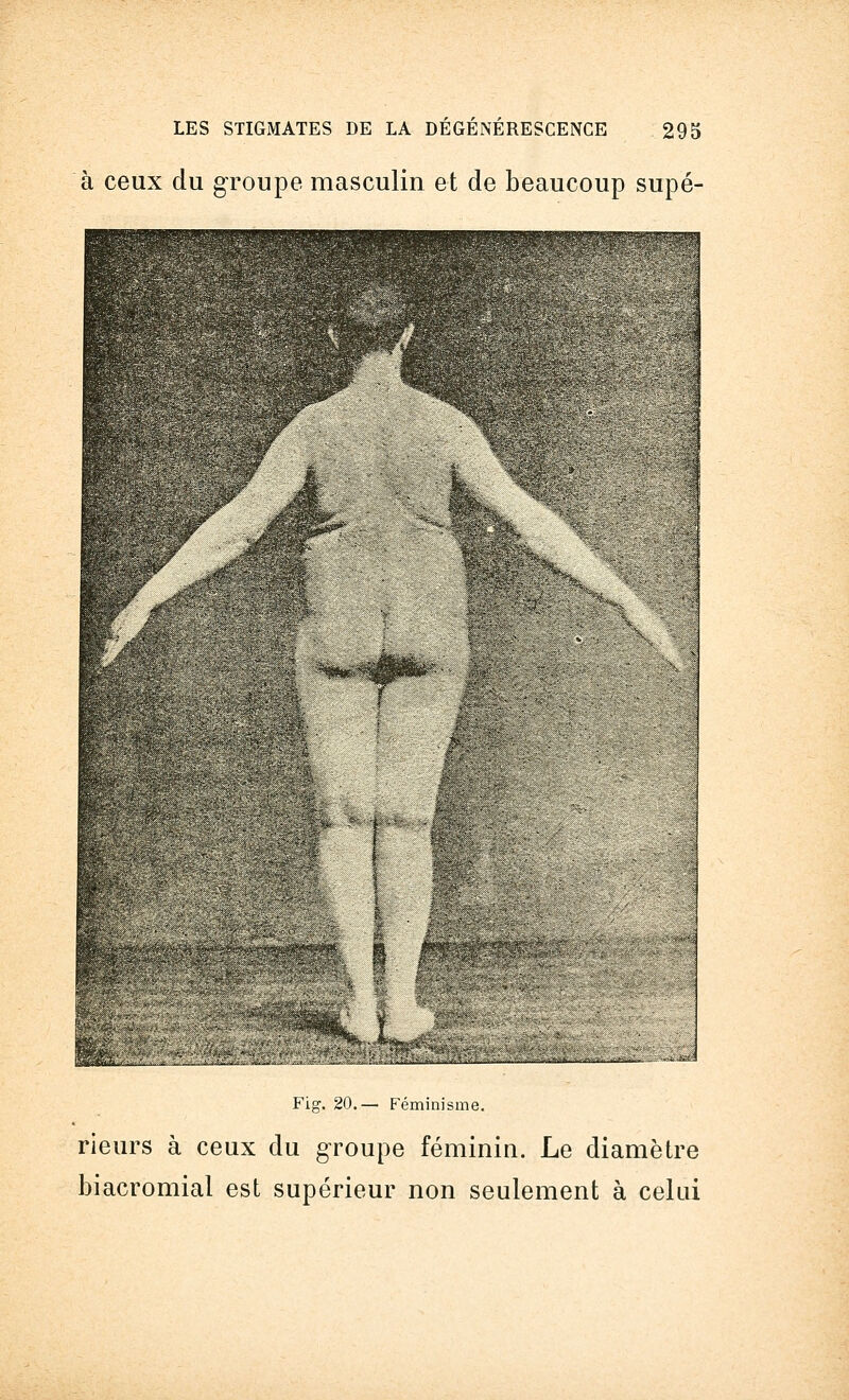 à ceux du groupe masculin et de beaucoup supé- ; JSBBBt Fig. 20.— Féminisme. ■ ■ . ...f,^- ..: rieurs à ceux du groupe féminin. Le diamètre biacromial est supérieur non seulement à celui
