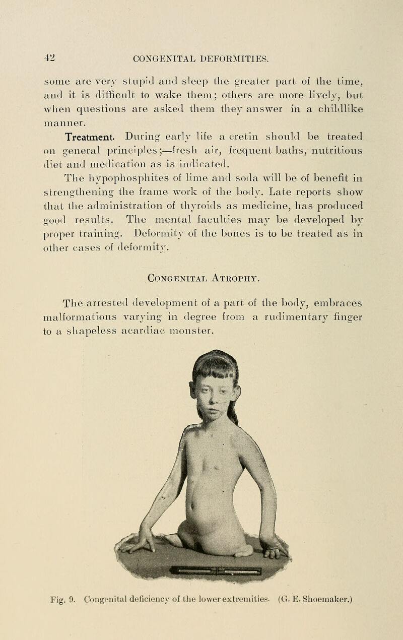 some are very stupid and sleep the greater part of the time, and it is difficult to wake them; others are more lively, but when questions are asked them they answer in a childlike manner. Treatment During early life a cretin should be treated on general principles;—fresh air, frequent baths, nutritious diet and medication as is indicated. The hypophosphites of lime and soda will be of benefit in strengthening the frame work of the body. Late reports show that the administration of thyroids as medicine, has produced good results. The mental faculties may be developed by proper training. Deformity of the bones is to be treated as in other cases of deformity. Congenital Atrophy. The arrested development of a part of the body, embraces malformations varying in degree from a rudimentary finger to a shapeless acardiac inonster. Fig. 0. Congenital deficiency of the lower extremities. (G. E. Shoemaker.)