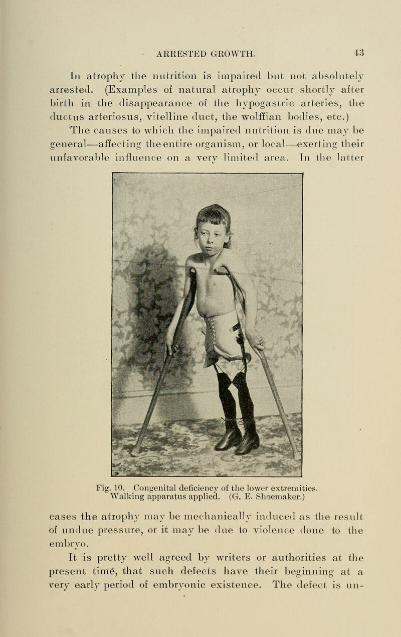 In atrophy the nutrition is impaired but not absolutely arrested. (Examples of natural atrophy occur shortly after birth in the disappearance of the liyiDogastric arteries, the ductus arteriosus, vitelline duct, the wolffian bodies, etc.) The causes to which the impaired nutrition is due may be general—affecting the entire organism, or local—exerting their unfavorable influence on a verv limited area. In the latter Fig. 10. Congenital deficiency of the lower extremities. Walking apparatus applied. (G. E. Shoemaker.) cases the atrophy may be mechanically induceil as the result of undue pressure, or it may be due to violence done to the embryo. It is pretty well agreed by writers or authorities at the present time, that such defects have their beginning at a very early period of embryonic existence. The defect is un-