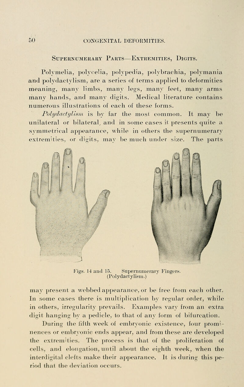 Supernumerary Parts—Extremities, Digits. Polymelia, polycelia, polypedia, polybrachia, polyniania and polydactylism, are a series of terms applied to deformities meaning, many limbs, many legs, many feet, many arms many hands, and many digits. Medical literature contains numerous illustrations of each of these forms. Polydactylism is by far the most common. It may be unilateral or bilateral, and in some cases it presents quite a symmetrical appearance, while in others the supernumerary extremities, or digits, may be much under size. The parts lf>. ''^ ''/i Figs. 14 and 15. Supernumeraiy Fingers. (Polydactylism.) may present a webbed appearance, or be free from each other. In some cases there is multiplication by regular order, while in others, irregularity prevails. Examples vary from an extra digit hanging by a pedicle, to that of any form of bifurca^tion. During the fifth week of embryonic existence, four promi- nences or embryonic ends appear, and from these are developed the extremities. The process is that of the proliferation of cells, and elongation, until about the eighth week, when the interdigital clefts make their appearance. It is during this pe- riod that the deviation occurs.