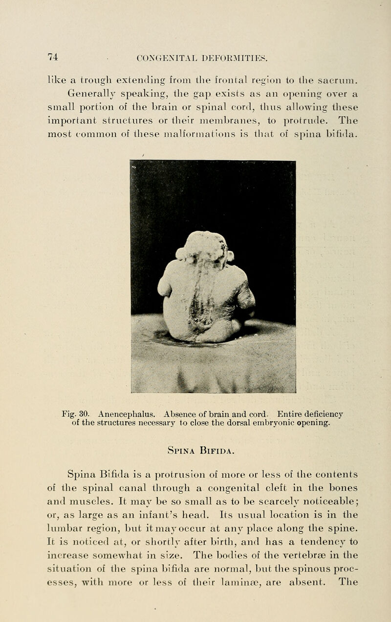 like a trough extending from the frontal region to the sacrum. Generally speakmg, the gap exists as an opening over a small portion of the brain or spinal cord, thus allowing these important structures or their membranes, to protrude. The most common of these malformations is that of spina bihda. Fig. 30. Anencephalus. Absence of brain and cord. Entire deficiency of the structures necessary to close the dorsal embryonic opening. Spina Bifida. Spina Bifida is a protrusion of more or less of the contents of the spinal canal through a congenital cleft in the bones and muscles. It may be so small as to be scarcely noticeable; or, as large as an infant's head. Its usual location is in the lumbar region, but it may occur at any place along the spine. It is noticed at, or shortly after birth, and has a tendency to increase somewhat in size. The bodies of the vertebrae in the situation of the spina bifida are normal, but the spinous proc- esses, with more or less of tlieir laminae, are absent. The