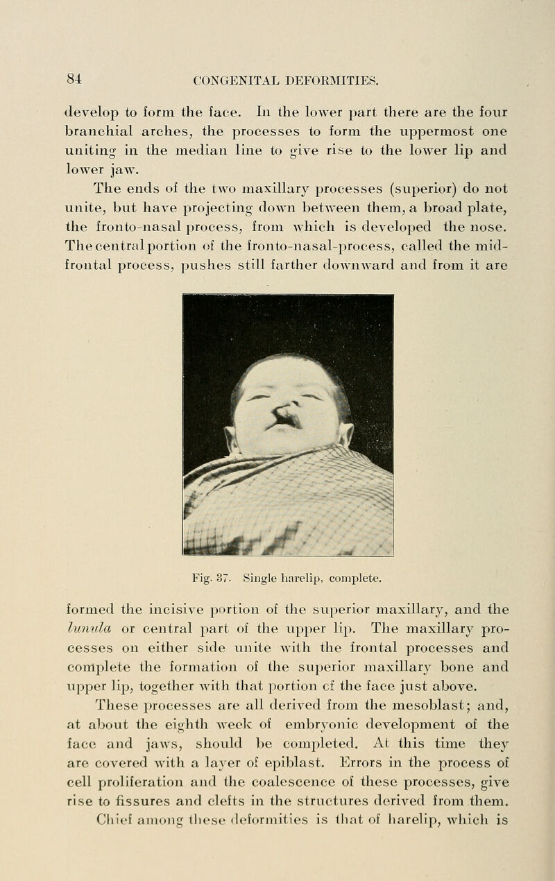 develop to form the face. In the lower part there are the four branchial arches, the processes to form the uppermost one unithig in the median line to give rise to the lower lip and loAver jaw. The ends of the two maxillary processes (superior) do not unite, but have projecting down betAveen them, a broad plate, the fronto-nasal process, from which is developed the nose. The central portion of the fronto-nasal-process, called the mid- frontal process, pushes still farther downward and from it are Fig. 37. Single harelip, complete. formed the incisive portion of the superior maxillary, and the lunula or central jDart of the upper lip. The maxillary pro- cesses on either side unite with the frontal processes and complete the formation of the superior maxillary bone and upper lip, together with that portion of the face just above. These jKocesses are all derived from the mesoblast; and, at aljout the eighth Aveek of embryonic development of the face and jaws, should be completed. At this time they are covered Avith a layer ol epiblast. Errors in the process of cell proliferation and the coalescence of these j^rocesses, give rise to fissures and clefts in the structures deriA^ed from them. Chief among these deformities is that of harelip, Avhicli is