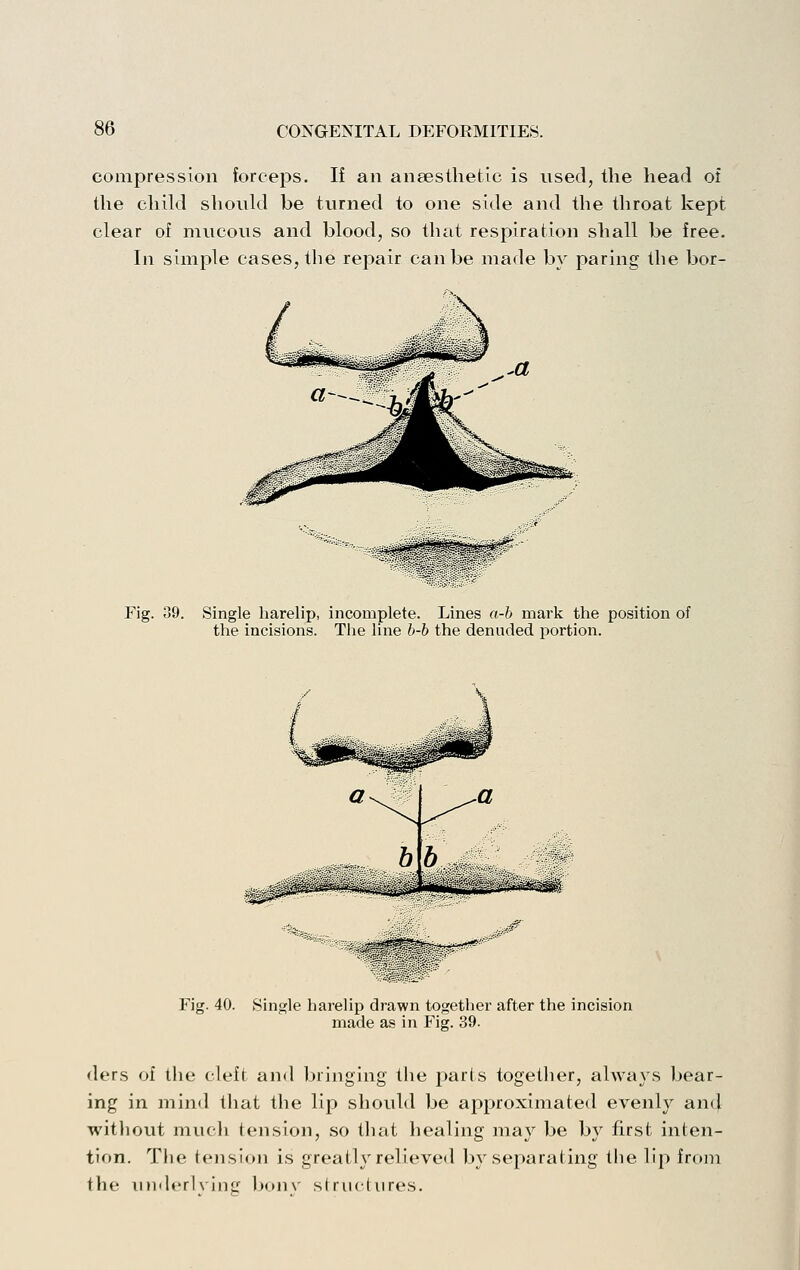 compression forceps. If an anaesthetic is used, the head of the child should be turned to one side and the throat kept clear of mucous and blood, so that respiration shall be free. In simjjle cases, the repair can be made by paring the bor- ^6?^ Fig. 39. Single harelip incomplete Lines a-b mark the position of the incibioiib. The line b b the denuded portion. Fig. 40. Single harelip drawn together after the incision made as in Fig. 39. ders of the cleft and bringing the parts together, always bear- ing in mind that the lip should be approximated evenly an(l without much tension, so that healing may be by first inten- tion. The tension is greatly relieved by separating the lip from the iind«'rl\ iiiL' b(>n\' siriiclures.