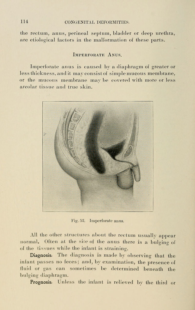 the rectum, anus, perineal septum, bladder or deep urethra, are etiological factors in the mallormation of these parts. Imperforate Anus. Imperforate anus is caused by a diaphragm of greater or less thickness, audit may consist of simple mucous membrane, or the mucous membrane may be covered with more or less areolar tissue and true skin. Fig. 53. Imperforate anus. All the other structures about the rectum usually appear normal. Often at the sire of the anus there is a bulgino' of of the tissues while the infant is straining. Diagnosis, The diagnosis is made by observing that the infant passes no feces; and, by examination, the presence of fluid or gas can sometimes be determined beneath the bulging diaphragm. Prognosis, Unless the infant is relieved by the third or