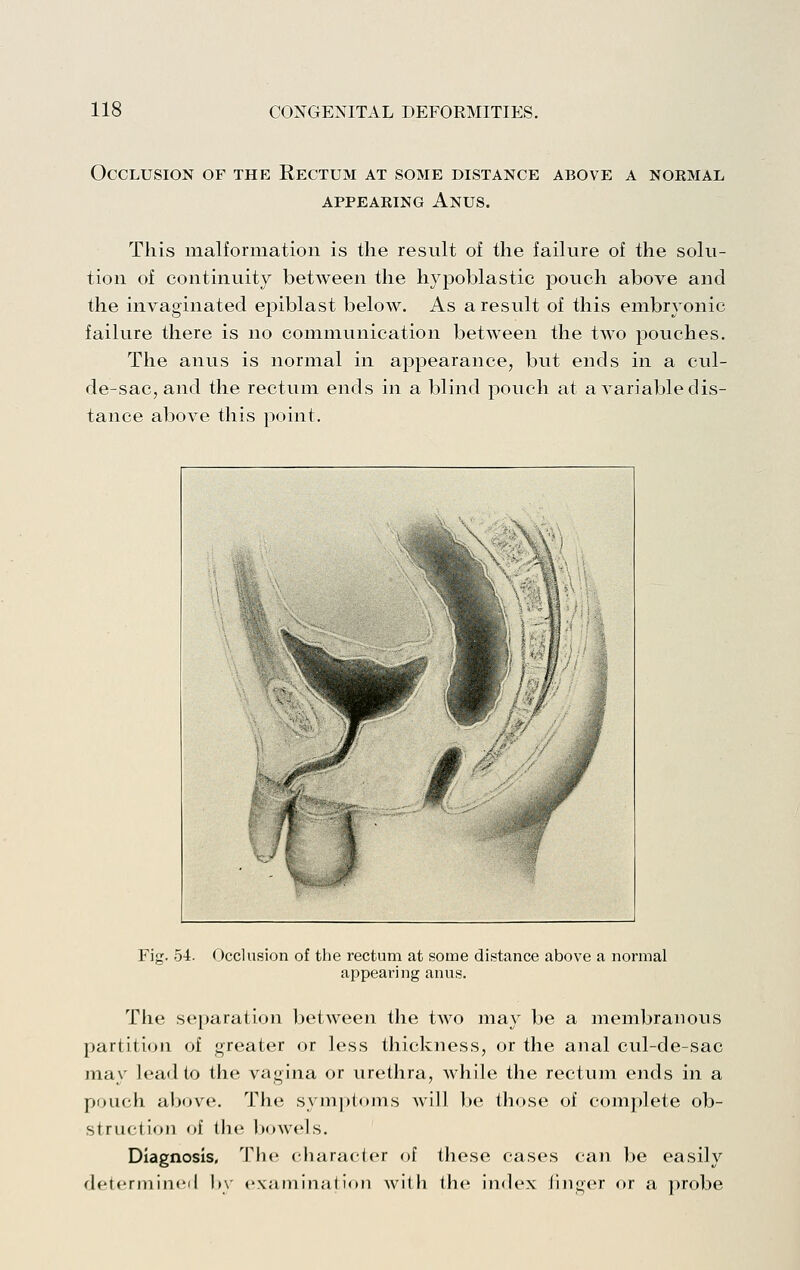 Occlusion of the Rectum at some distance above a nokmal APPEAKiNG Anus. This inalformation is the result of the failure of the solu- tion of continuity between the hypoblastic pouch above and the invaginated epiblast below. As a result of this embryonic failure there is no communication between the two pouches. The anus is normal in appearance, but ends in a cul- de-sac, and the rectum ends in a blind pouch at a A^ariable dis- tance above this point. Fig. 54. Occlusion of the rectum at some distance above a normal appearing anus. The separation between the two may be a membranous partition of greater or less thickness, or the anal cul-de-sac may lead to the vagina or urethra, while the rectum ends in a pouch above. The sym[)t<)ms Avill be those of complete ob- struction of the Ixjwels. Diagnosis, Th(i chara(;ter of these cases can be easily determincil by cxaniinat ion with the inch'x (ingor or a probe