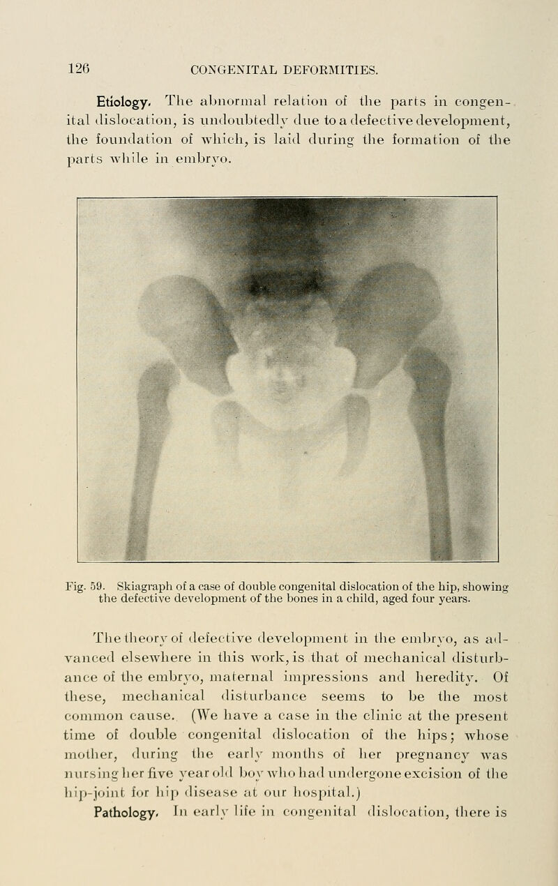 Etiology, The abnormal relation of the parts in congen- ital dislocation, is undoubtedly due to a defective development, the foundation of Avliich, is laid during the formation of the parts while in embryo. Fig. 59. Skiagraph of a case of double congenital dislocation of the hip, showing the defective development of the bones in a child, aged four years. The theory of defective development in the embryo, as ad- vanced elsewhere in this work, is that of mechanical disturb- ance of the embryo, maternal impressions and heredity. Of these, mechanical disturbance seems to be the most common cause. (We have a case in the clinic at the present time of double congenital dislocation of the hijDs; whose mother, during the early months of lier pregnancy was nursing her five year old boy who had undergone excision of the hip-joint for liip disease at our hospital.) Pathology. In early life in congenital dislocation, there is