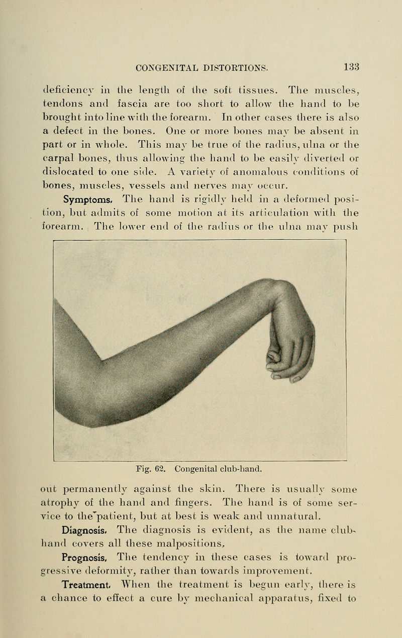 deficiency in the length of the soft tissues. The muscles, tendons and fascia are too short to allow the hand to be brought into line Avith the forearm. In other cases there is also a defect in the bones. One or more bones may be absent in part or in whole. This may be true of the radius, ulna or the carpal bones, thus allowing the hand to be easily diverted or dislocated to one side. A variety of anomalous conditions of bones, muscles, vessels and nerves may occur. Symptoms, The hand is rigidly held in a deformed posi- tion, but admits of some motion at its articulation with the forearm. The lower end of the radius or the ulna may push Fig. 62. Congenital club-hand. out ^permanently against the skin. There is usually some atrophy of the hand and fingers. The hand is of some ser- vice to the^patient, but at best is weak and unnatural. Diagnosis, The diagnosis is evident, as the name club- hand covers all these malpositions. Prognosis, The tendency in these cases is toward pro- gressive deformity, rather than towards improvement. Treatment, When the treatment is begun early, there is a chance to effect a cure by mechanical apparatus, fixed to