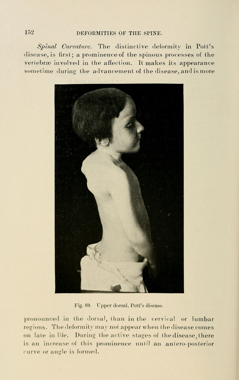 Spinal Curvature. The distinctive deformity in Pott's disease, is first; a prominence of the spinous processes of the vertebrae involved in the affection. It makes its appearance sometime during the advancement of the disease, and is more Fig. G9. Upper dorsal, Pott's disease. pronounced in the dorsal, than in the cervical or lumbar regions. The deformity may not appear when the disease comes on late in life. During the active stages of thedisease^there is an increase of this |»rominence iiidil an aniero-posterior curve or angle is fornicl.