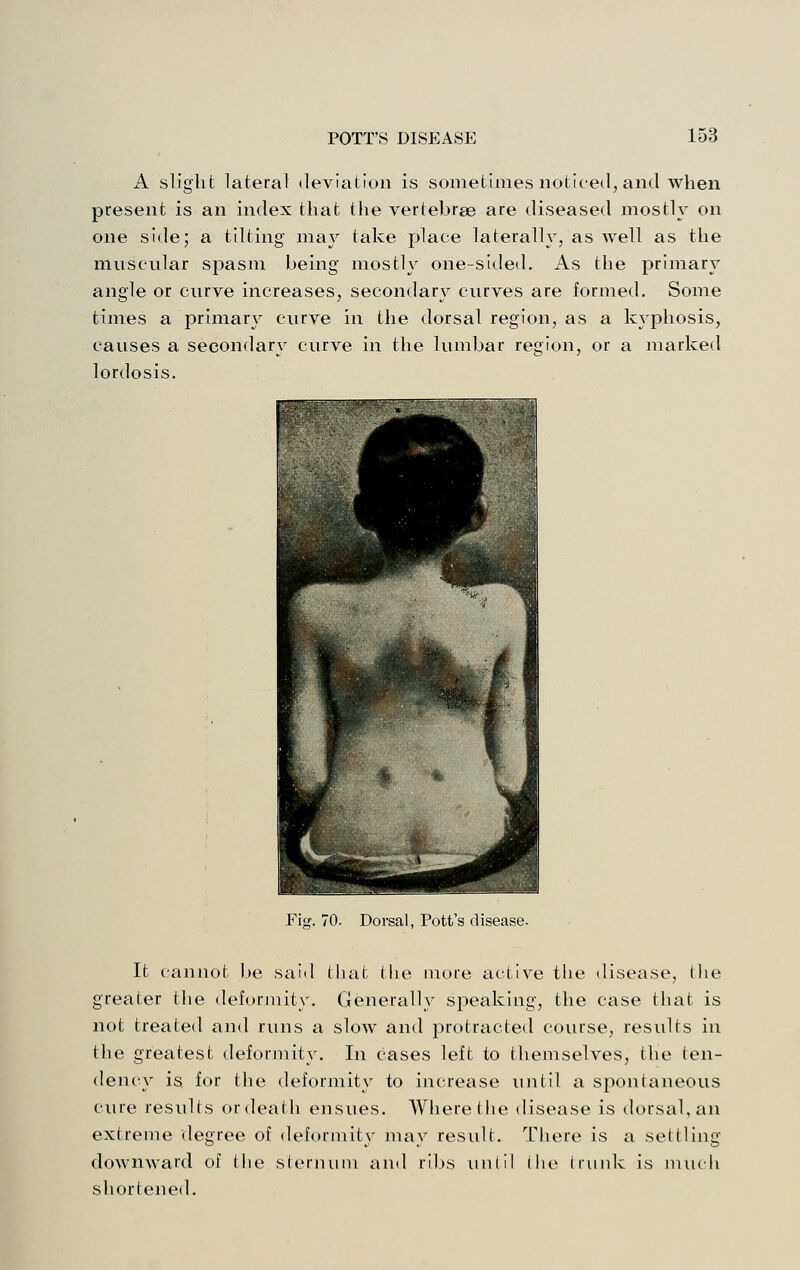 A slight lateral deviation is sometimes noticed, and when present is an index that the vertebrae are diseased mostly on one side; a tilting may take place laterally, as well as the mnscnlar spasm being mostly one-sided. As the primary angle or curve increases, secondary curves are formed. Some times a primary curve in the dorsal region, as a kyphosis, causes a secondary curve in the lumbar region, or a marked lordosis. Fig. 70. Dorsal, Pott's disease. It cannot be said that the more active the disease, the greater the deformity. Generally speaking, the case that is not treated and runs a slow and protracted course, results in the greatest deformity. In cases left to themselves, the ten- dency is for the deformity to increase until a spontaneous cure results or death ensues. Where the disease is dorsal, an extreme degree of deformity may result. There is a settling downward of the sternum and ribs until the trunk is much siiortened.
